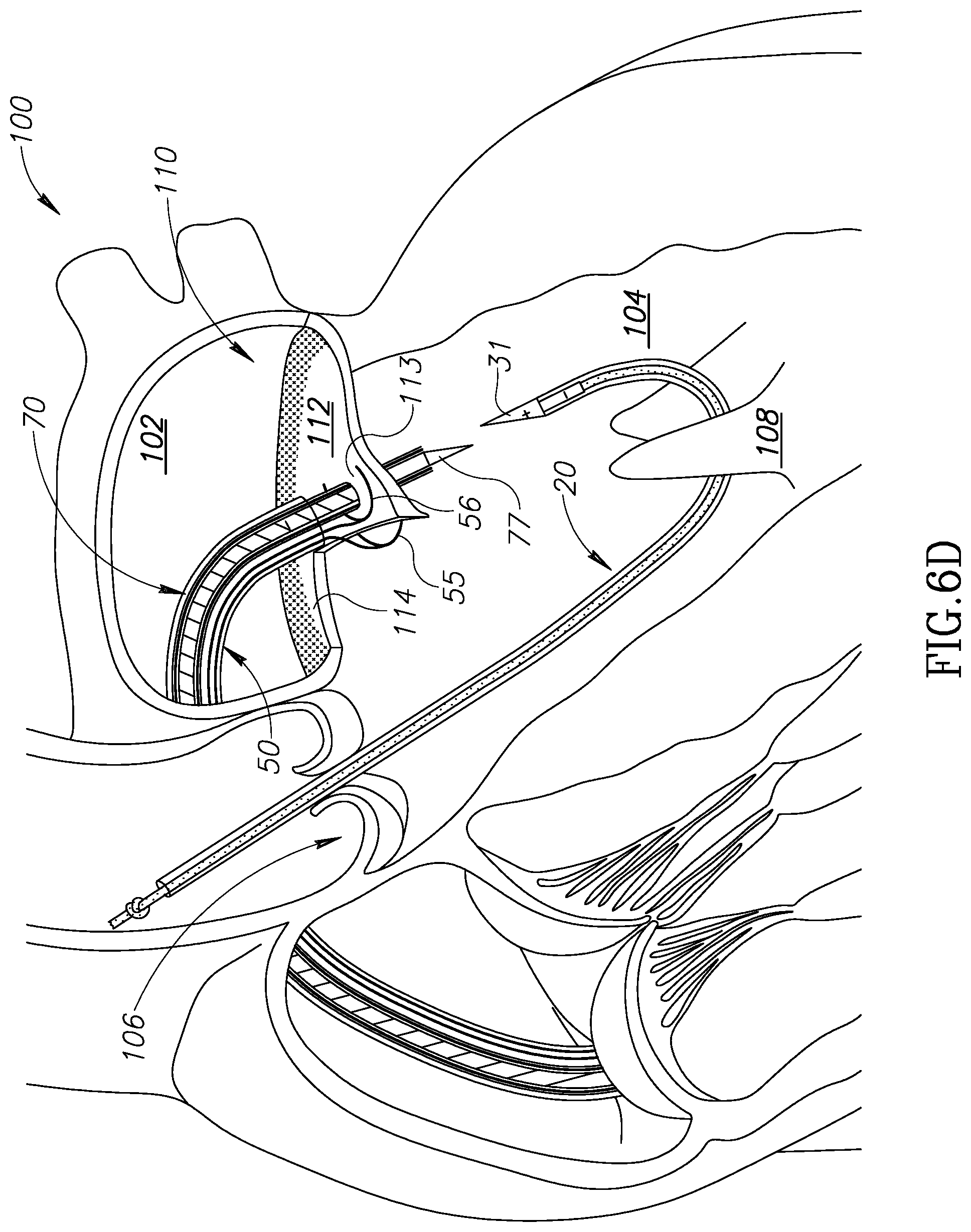Patent US12310852 Figure 11 – Chorda replacement apparatus and method