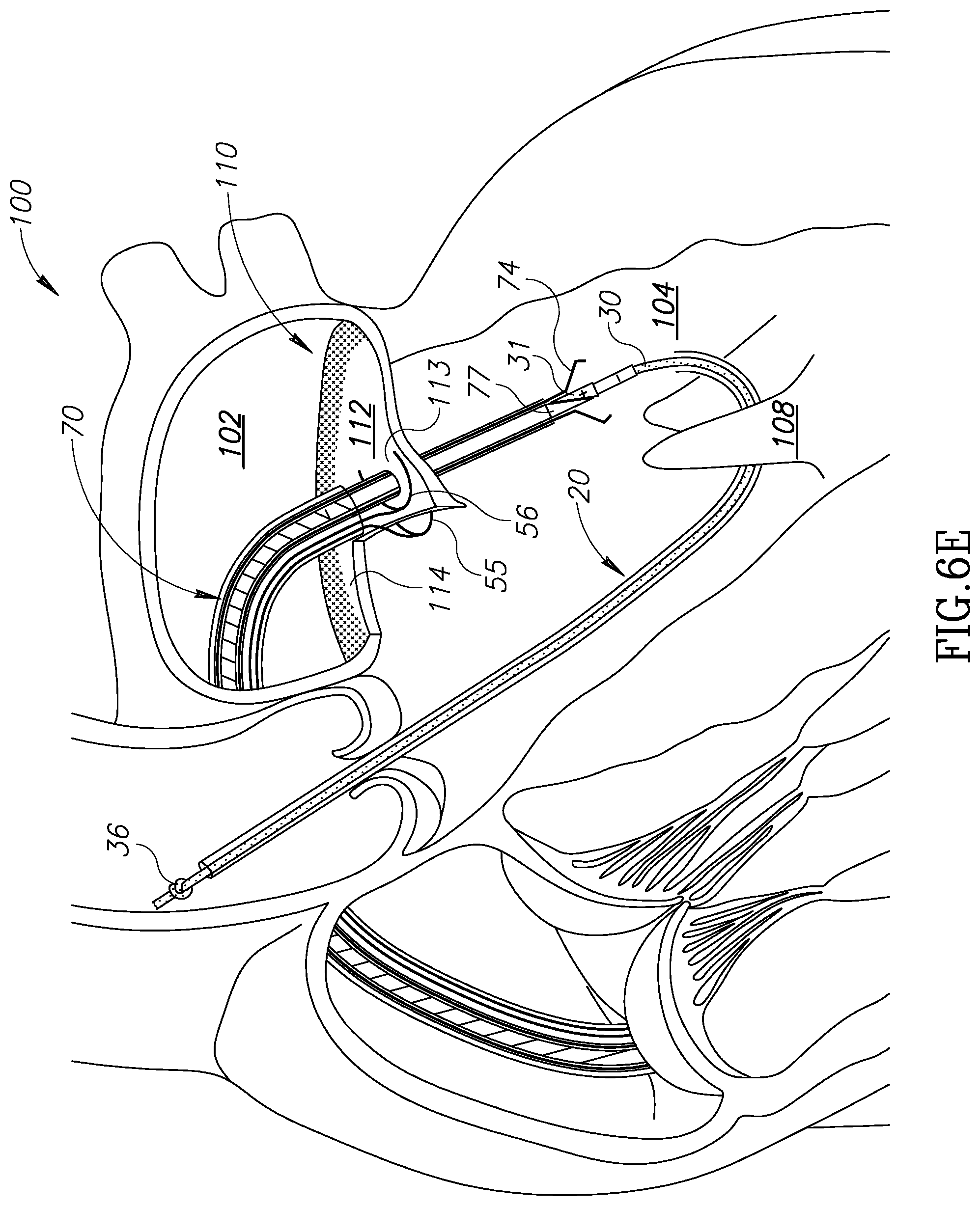 Patent US12310852 Figure 12 – Chorda replacement apparatus and method