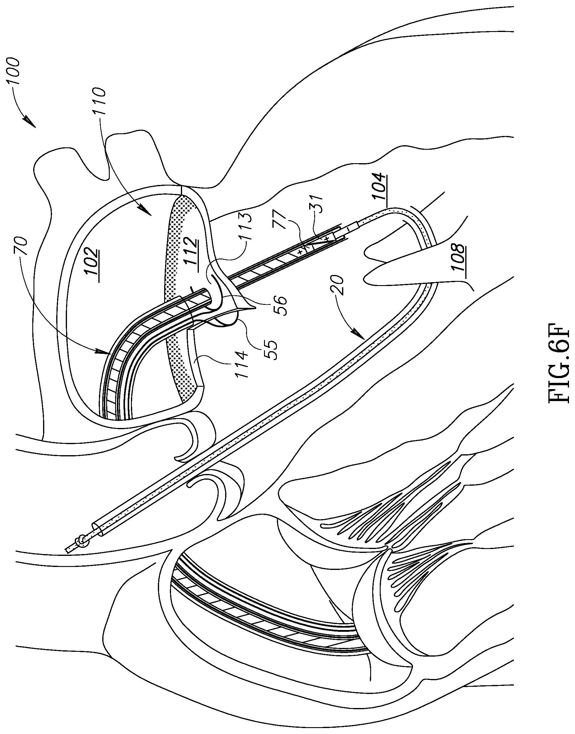 Patent US12310852 Figure 13 – Chorda replacement apparatus and method