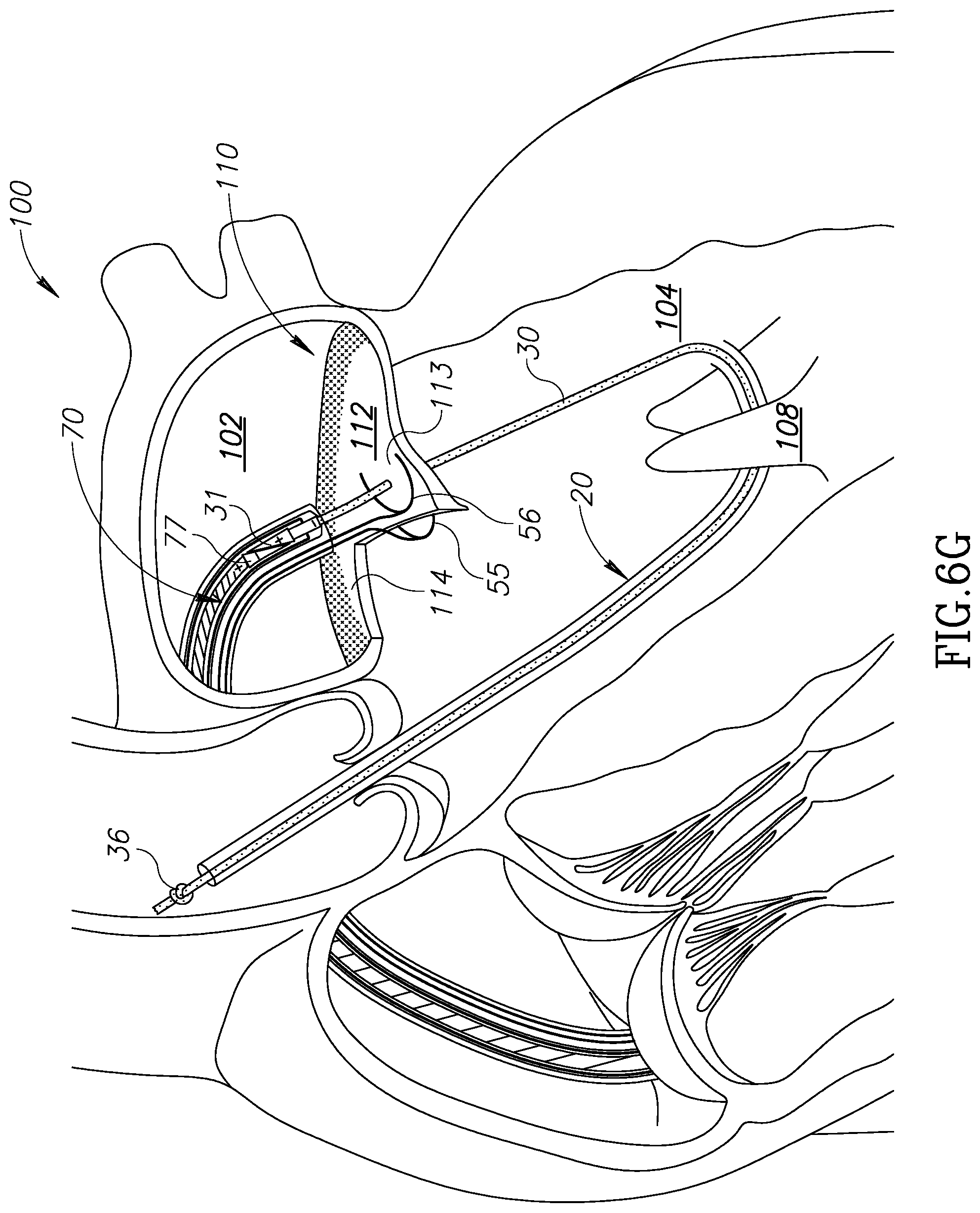 Patent US12310852 Figure 14 – Chorda replacement apparatus and method