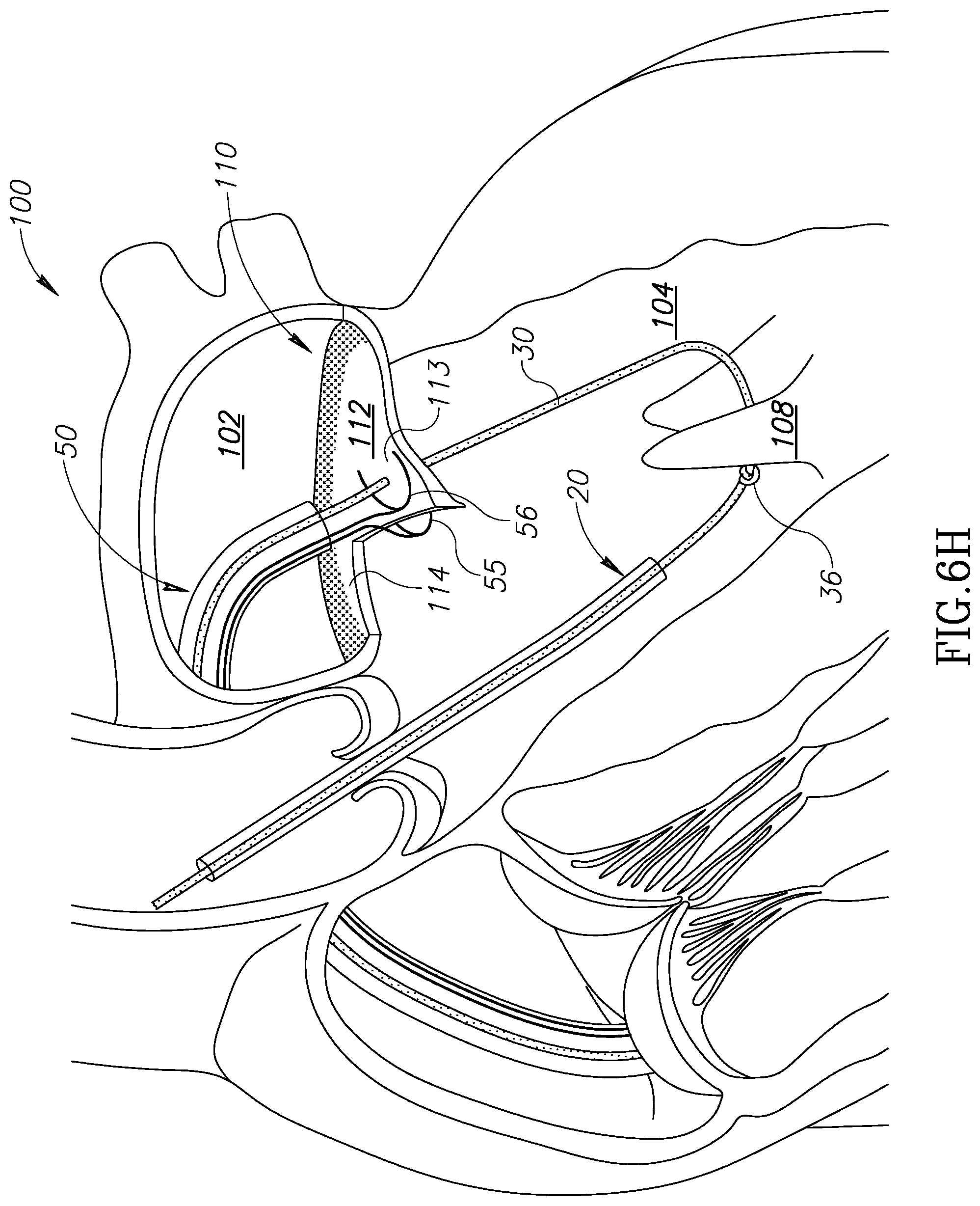 Patent US12310852 Figure 15 – Chorda replacement apparatus and method
