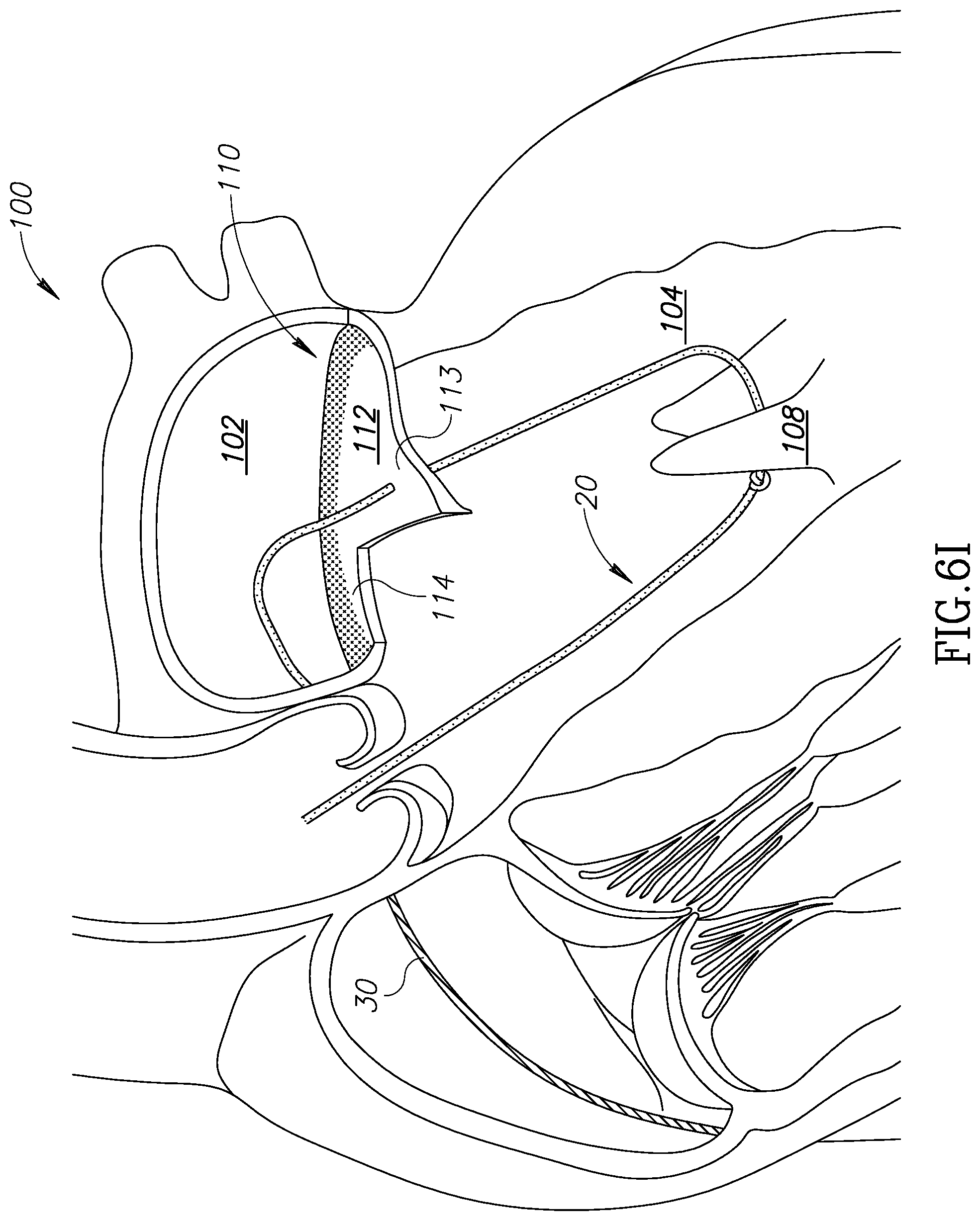 Patent US12310852 Figure 16 – Chorda replacement apparatus and method