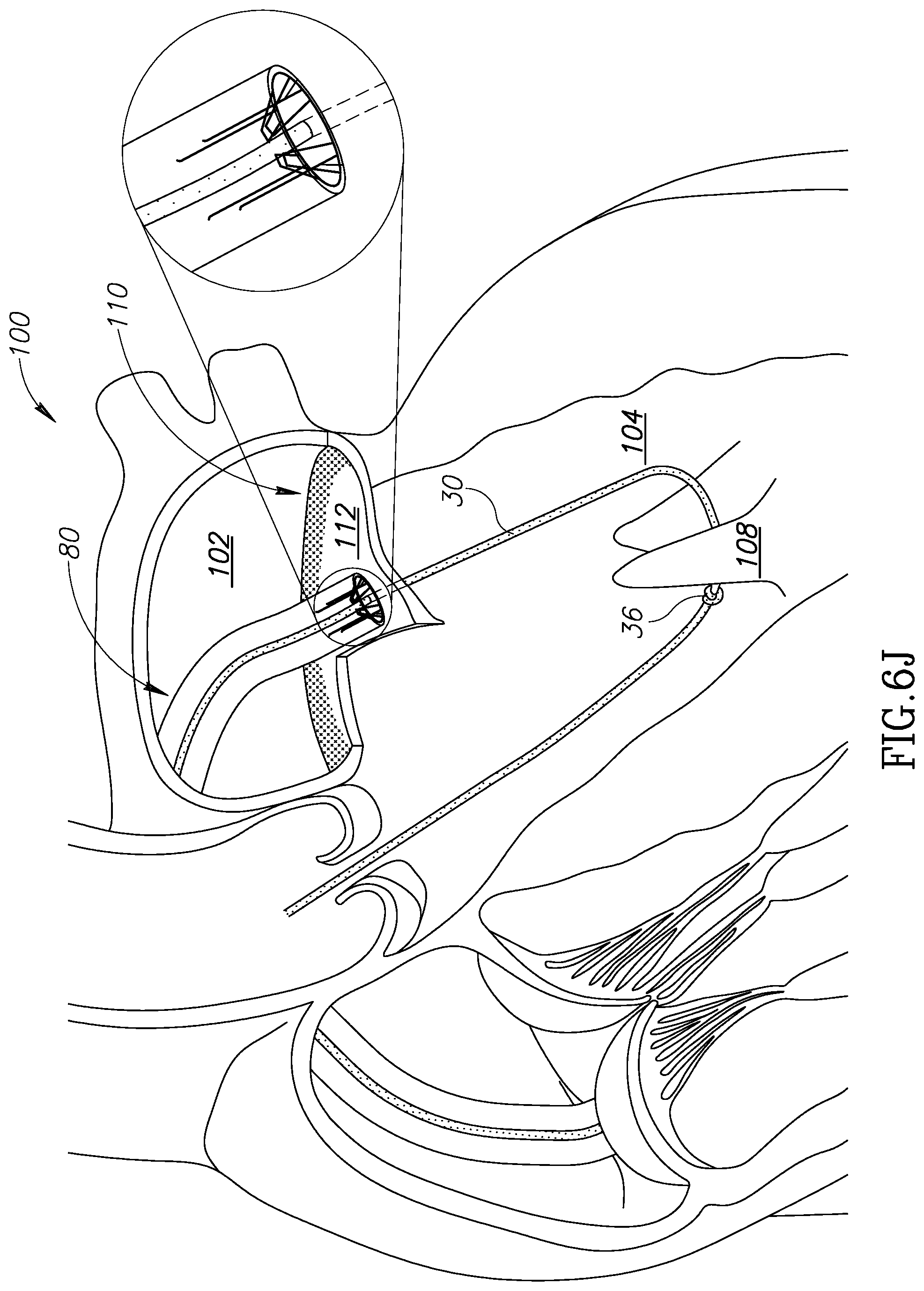 Patent US12310852 Figure 17 – Chorda replacement apparatus and method