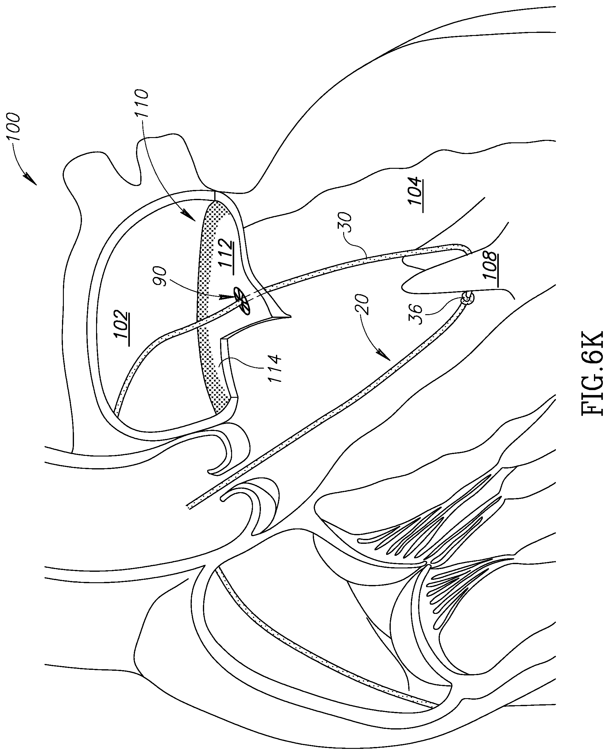 Patent US12310852 Figure 18 – Chorda replacement apparatus and method