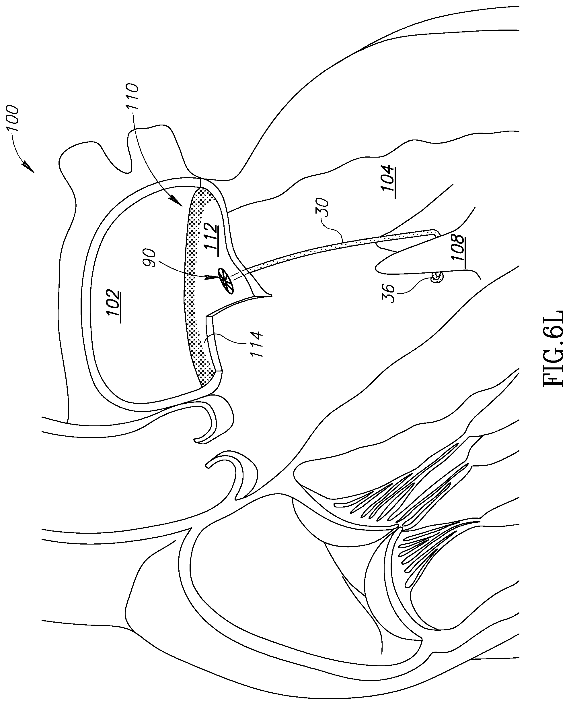 Patent US12310852 Figure 19 – Chorda replacement apparatus and method