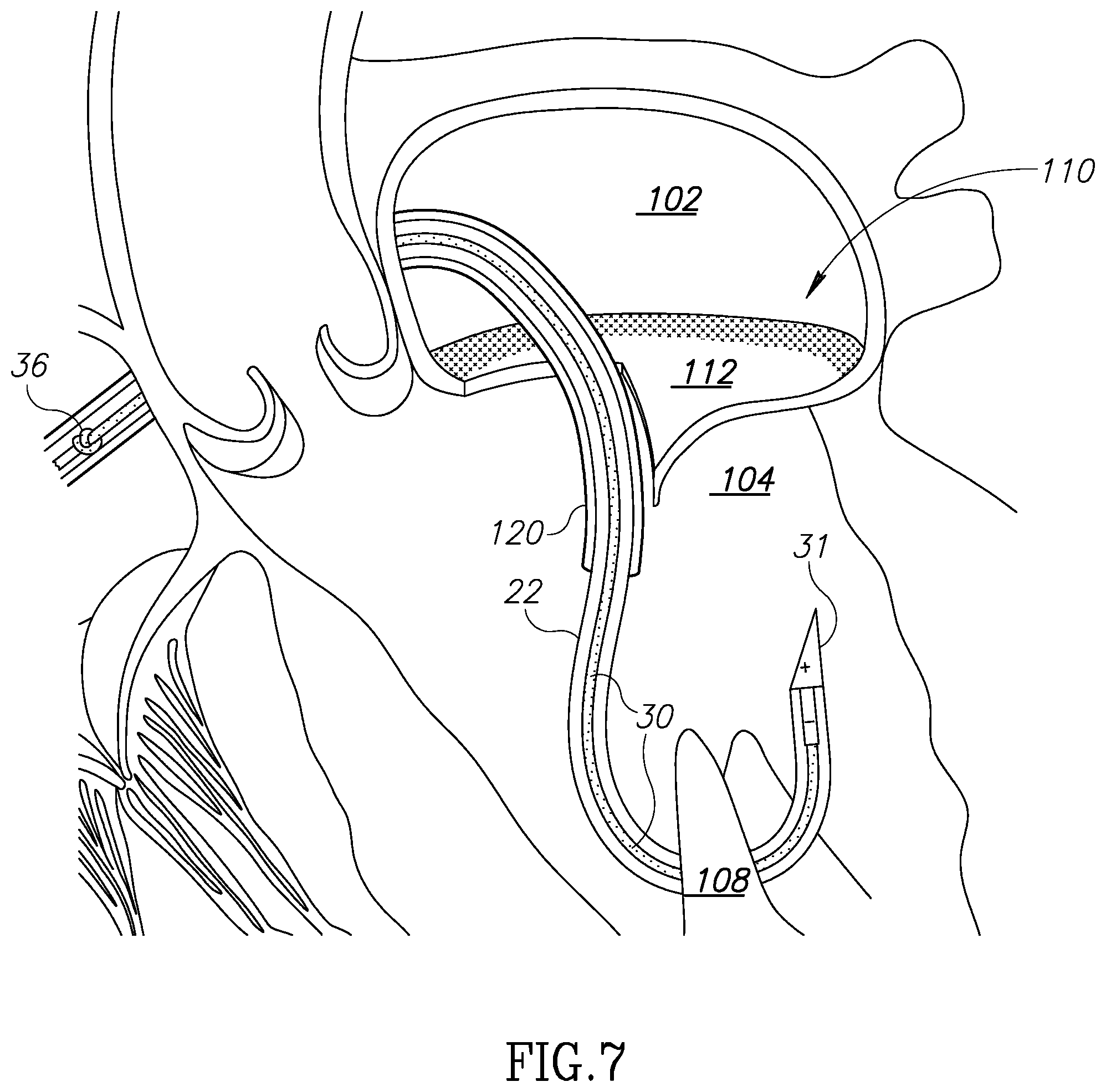 Patent US12310852 Figure 20 – Chorda replacement apparatus and method