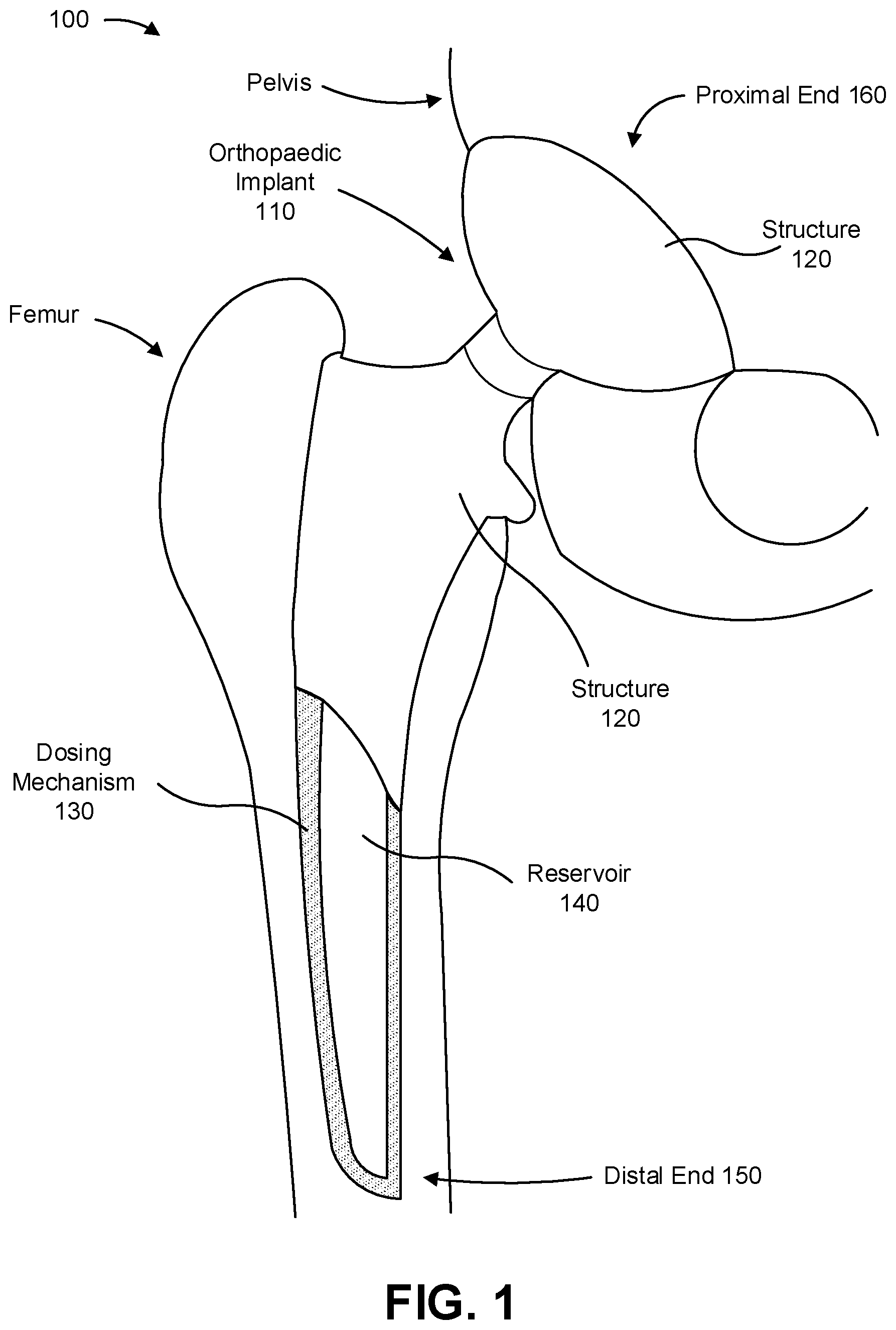 Patent US12310854 — Orthopaedic implant to administer a medical substance — Figure 1