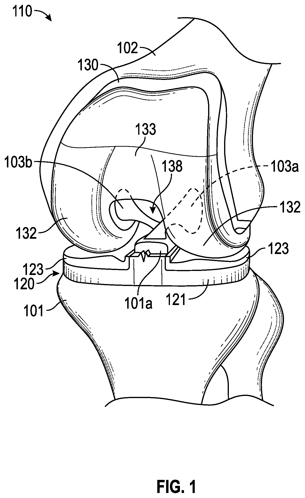 Patent US12310856 Figure 1 – Femoral component for bone conservation