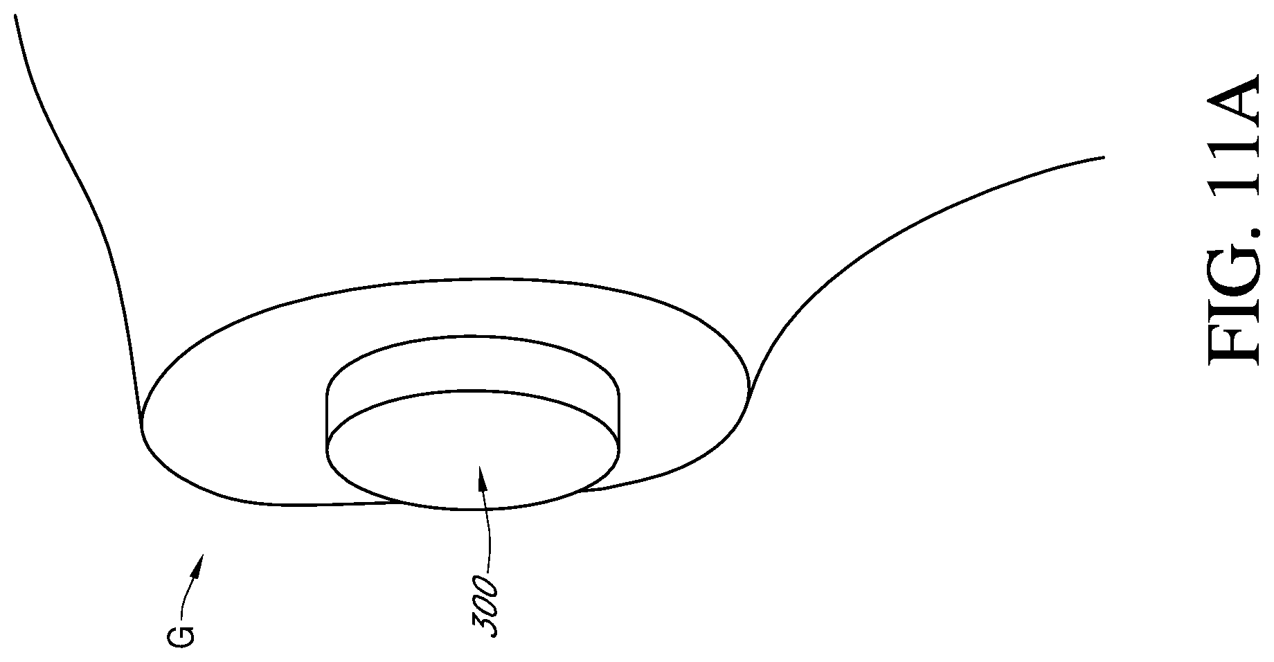 Patent US12310857 Figure 13 – Total shoulder prosthesis having inset glenoid implant convertible from anatomic to reverse