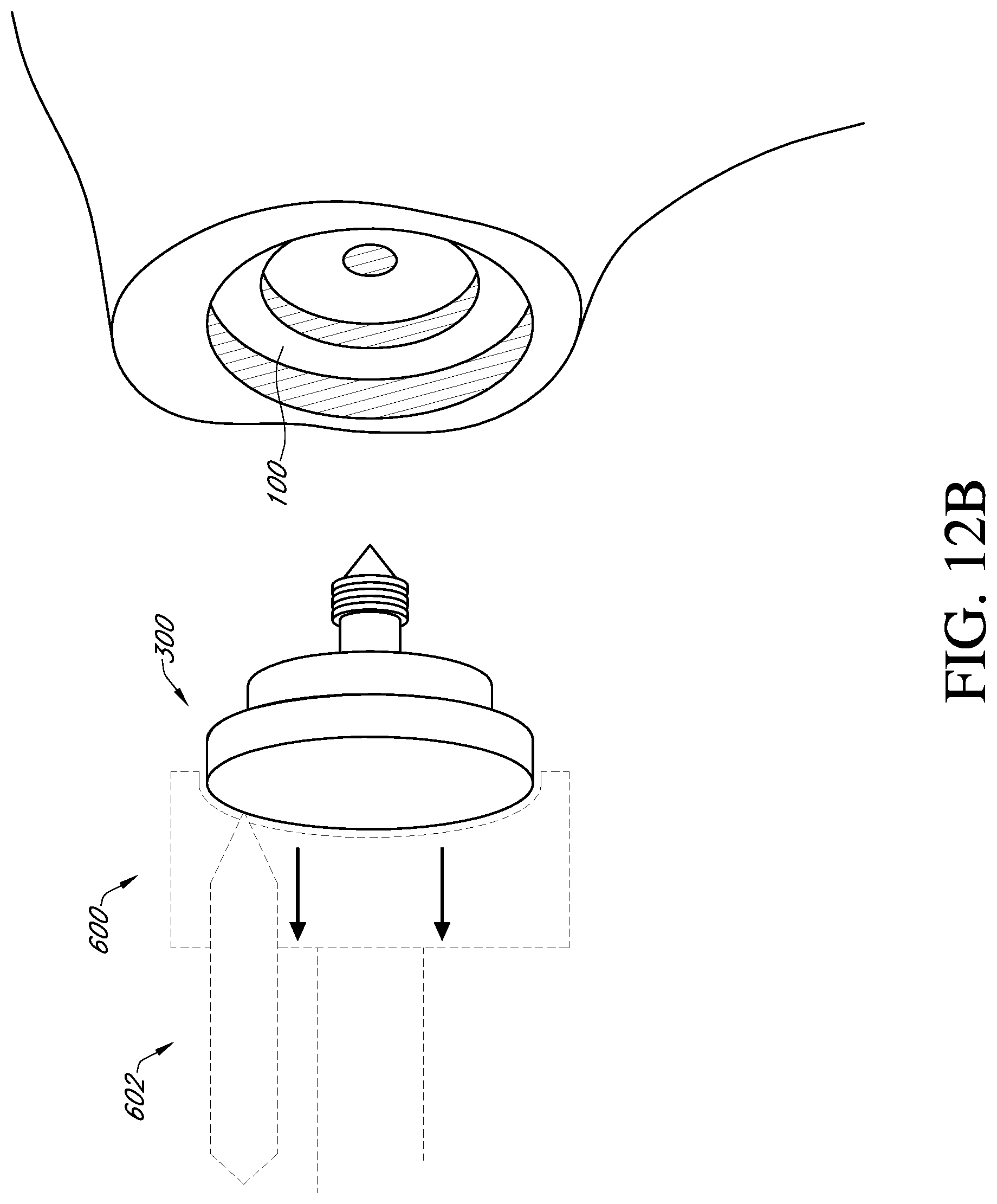 Patent US12310857 Figure 18 – Total shoulder prosthesis having inset glenoid implant convertible from anatomic to reverse