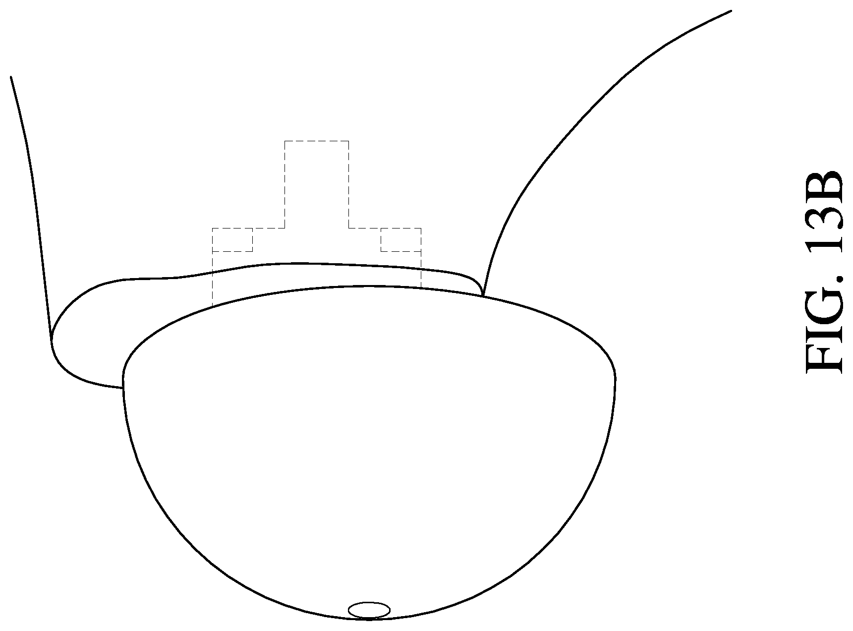 Patent US12310857 Figure 20 – Total shoulder prosthesis having inset glenoid implant convertible from anatomic to reverse