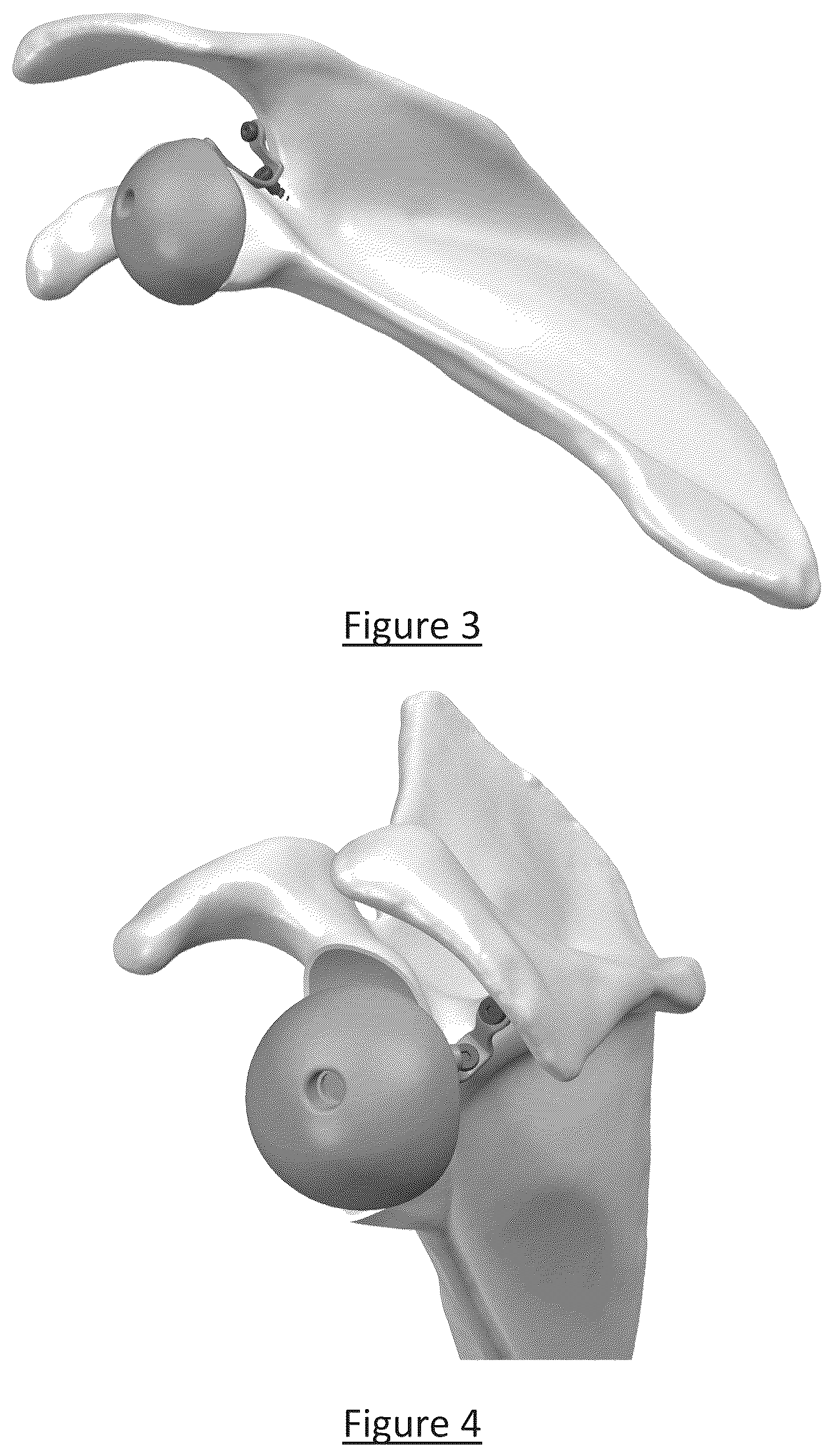 Patent US12310858 Figure 3 – Platform RTSA glenoid prosthesis with modular attachments capable of improving initial fixation, fracture reconstructions, and joint biomechanics