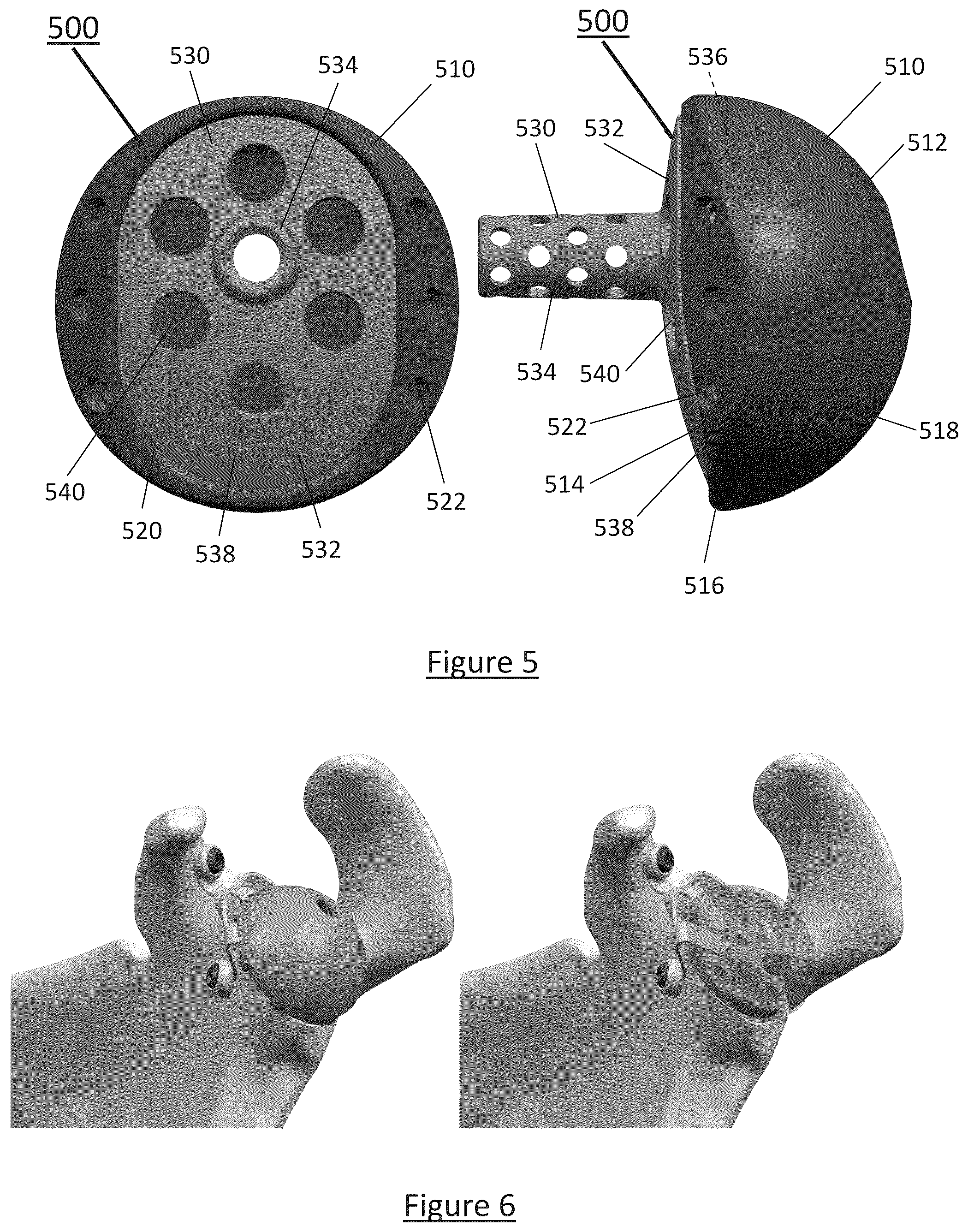 Patent US12310858 Figure 4 – Platform RTSA glenoid prosthesis with modular attachments capable of improving initial fixation, fracture reconstructions, and joint biomechanics