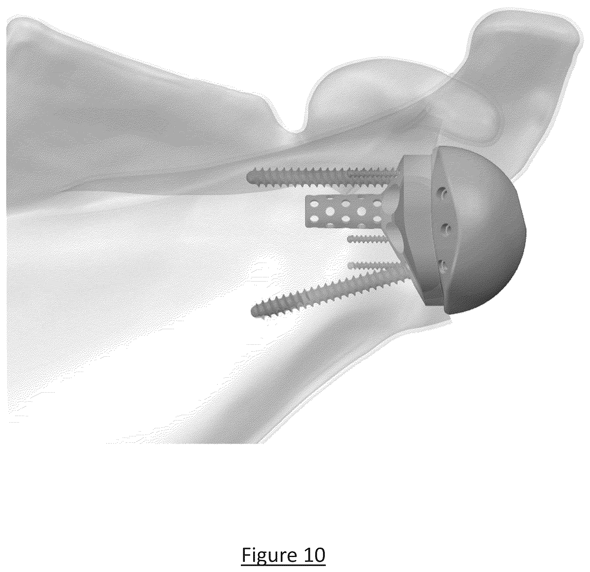Patent US12310858 Figure 7 – Platform RTSA glenoid prosthesis with modular attachments capable of improving initial fixation, fracture reconstructions, and joint biomechanics