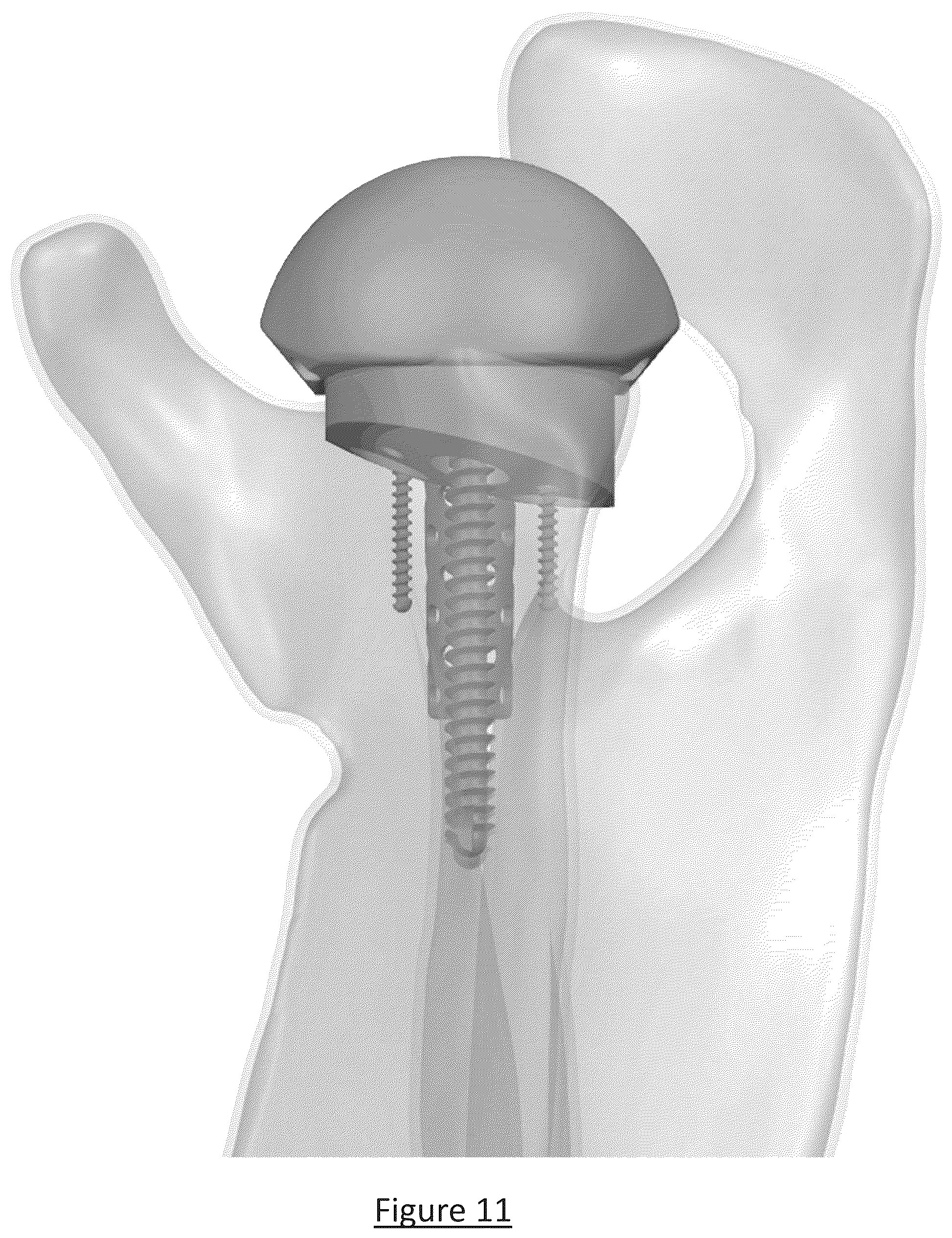 Patent US12310858 Figure 8 – Platform RTSA glenoid prosthesis with modular attachments capable of improving initial fixation, fracture reconstructions, and joint biomechanics