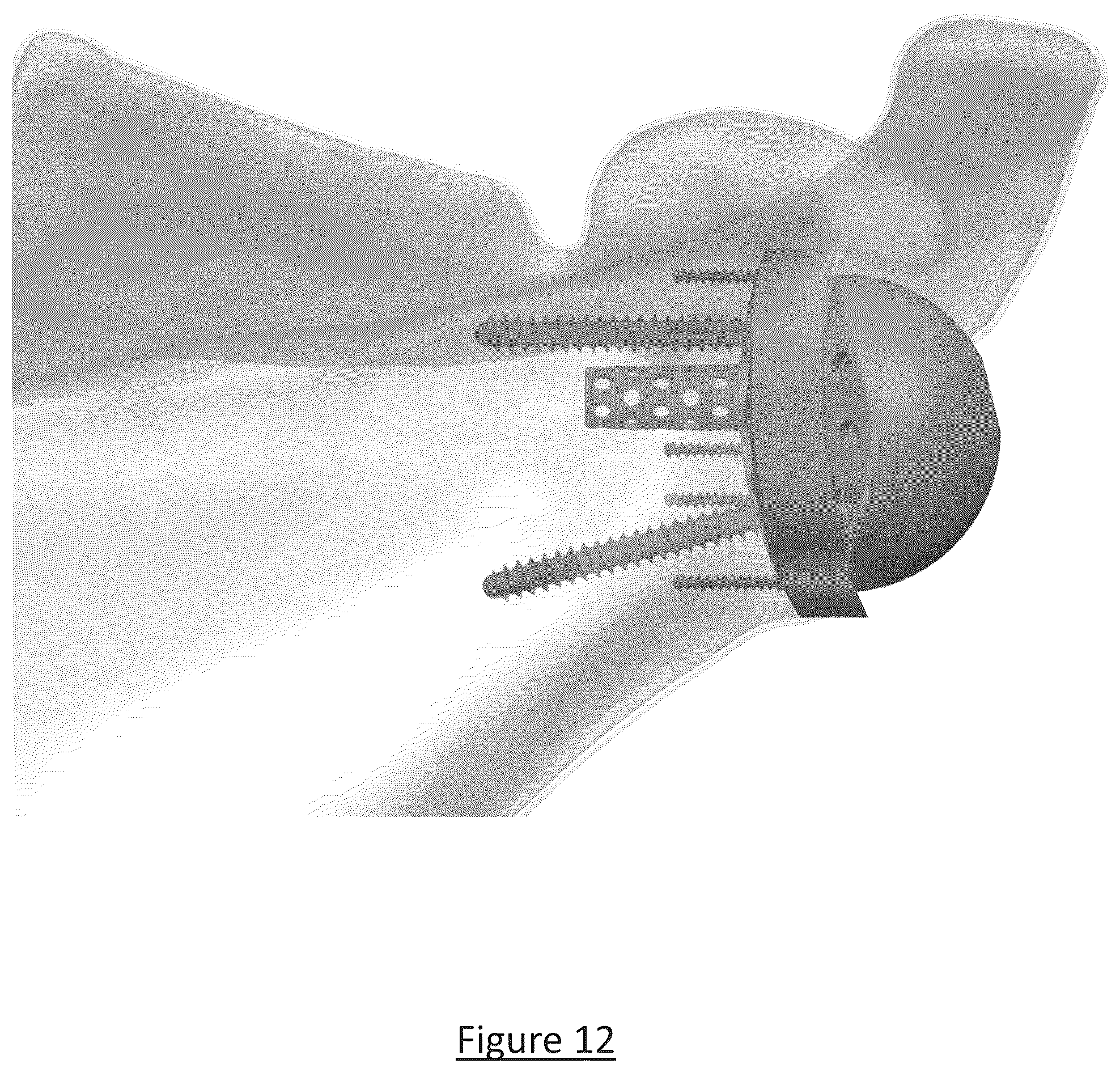 Patent US12310858 Figure 9 – Platform RTSA glenoid prosthesis with modular attachments capable of improving initial fixation, fracture reconstructions, and joint biomechanics