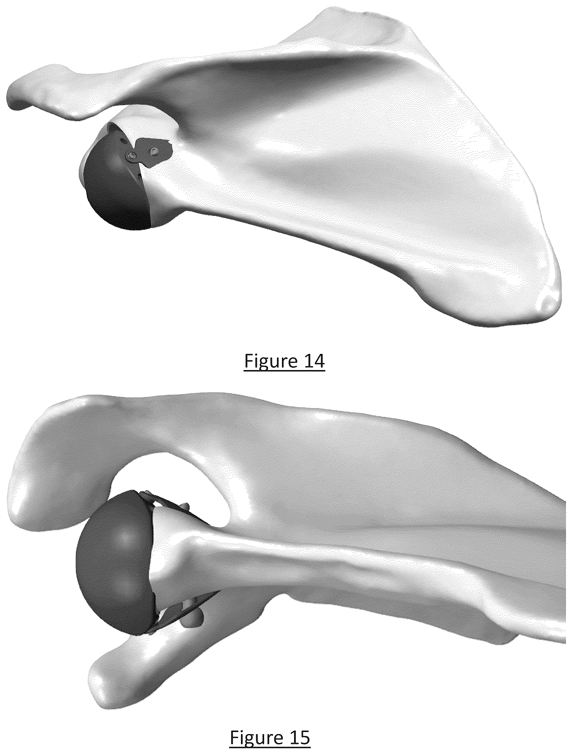Patent US12310858 Figure 11 – Platform RTSA glenoid prosthesis with modular attachments capable of improving initial fixation, fracture reconstructions, and joint biomechanics