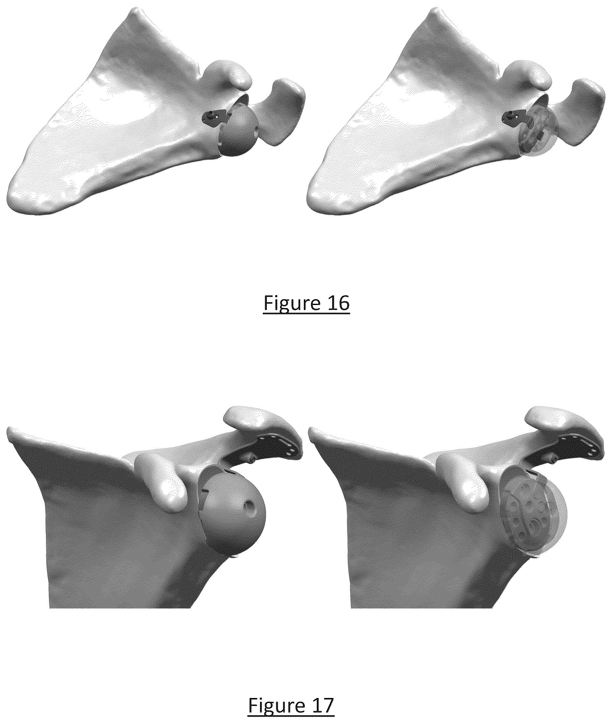 Patent US12310858 Figure 12 – Platform RTSA glenoid prosthesis with modular attachments capable of improving initial fixation, fracture reconstructions, and joint biomechanics