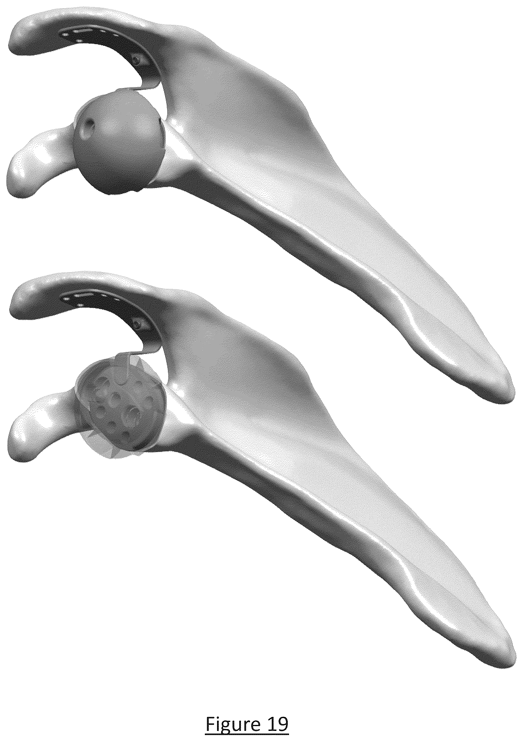 Patent US12310858 Figure 14 – Platform RTSA glenoid prosthesis with modular attachments capable of improving initial fixation, fracture reconstructions, and joint biomechanics