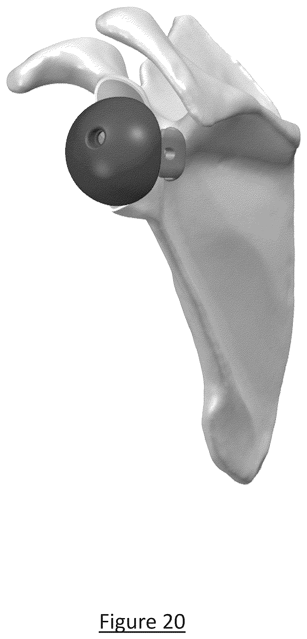 Patent US12310858 Figure 15 – Platform RTSA glenoid prosthesis with modular attachments capable of improving initial fixation, fracture reconstructions, and joint biomechanics