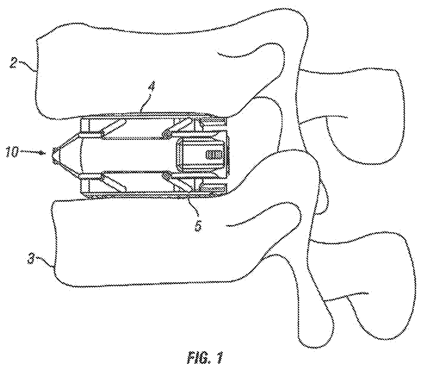 Patent US12310860 Figure 1 – Expandable fusion device and method of installation thereof