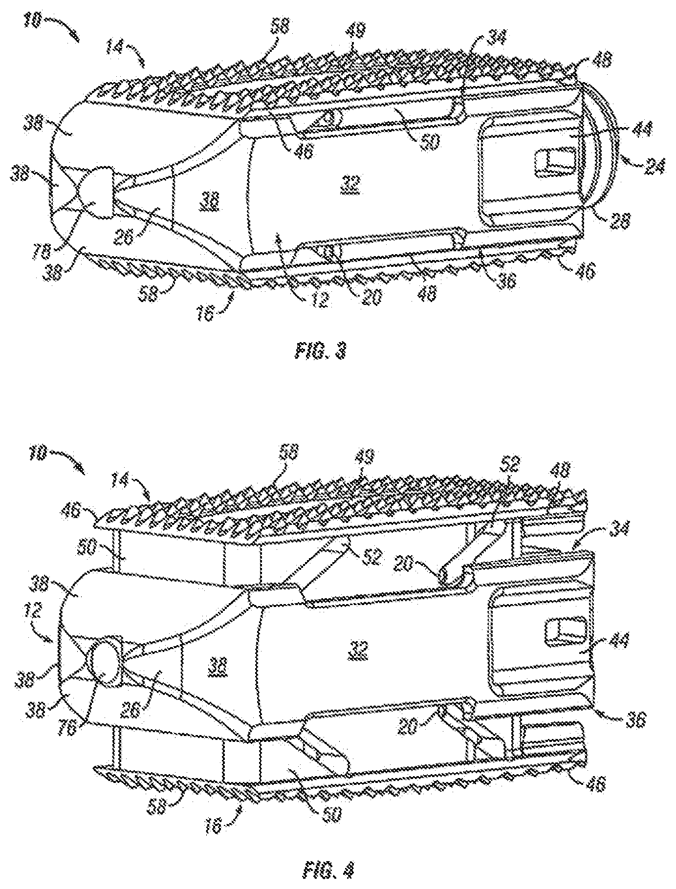 Patent US12310860 Figure 3 – Expandable fusion device and method of installation thereof