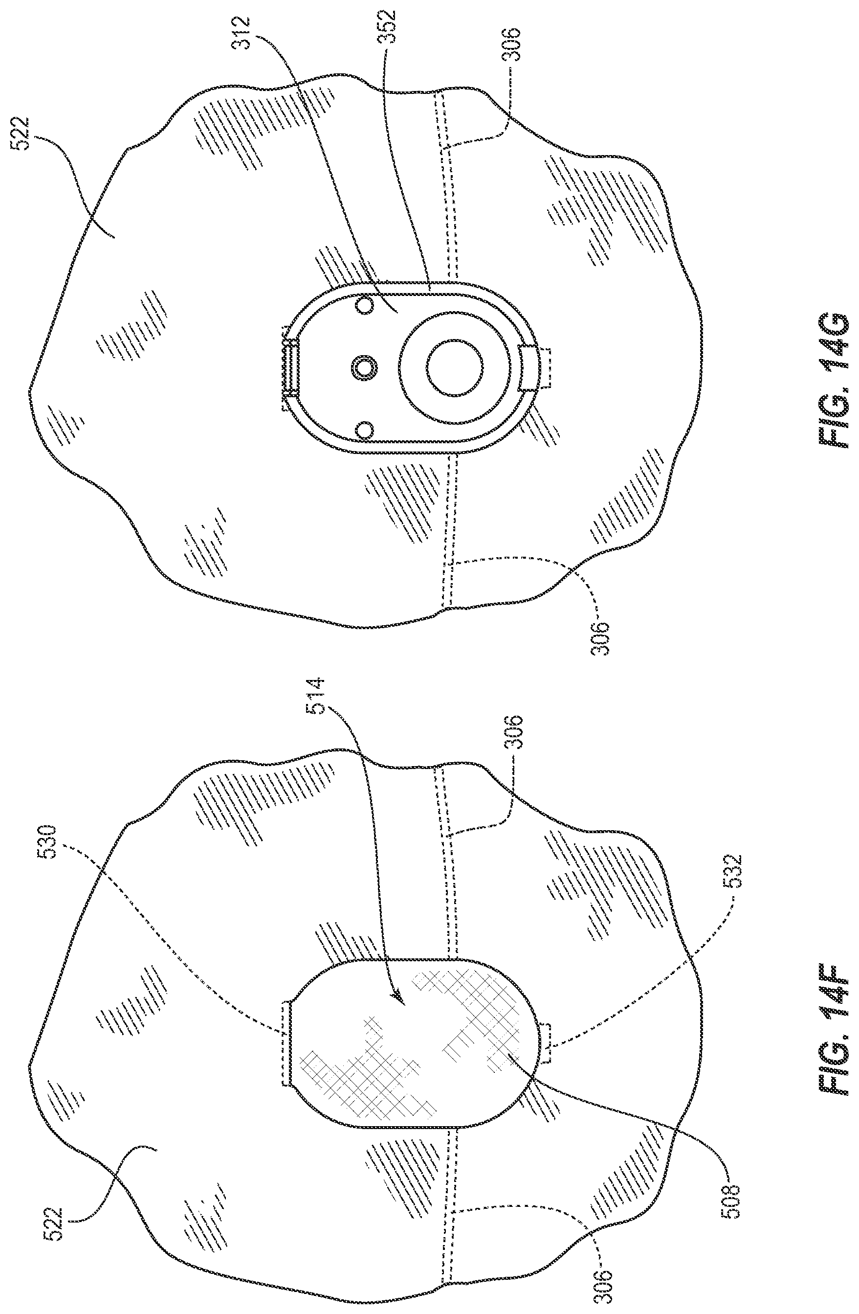 Patent US12310864 Figure 15 – Adjustable prosthetic interfaces and related systems and methods
