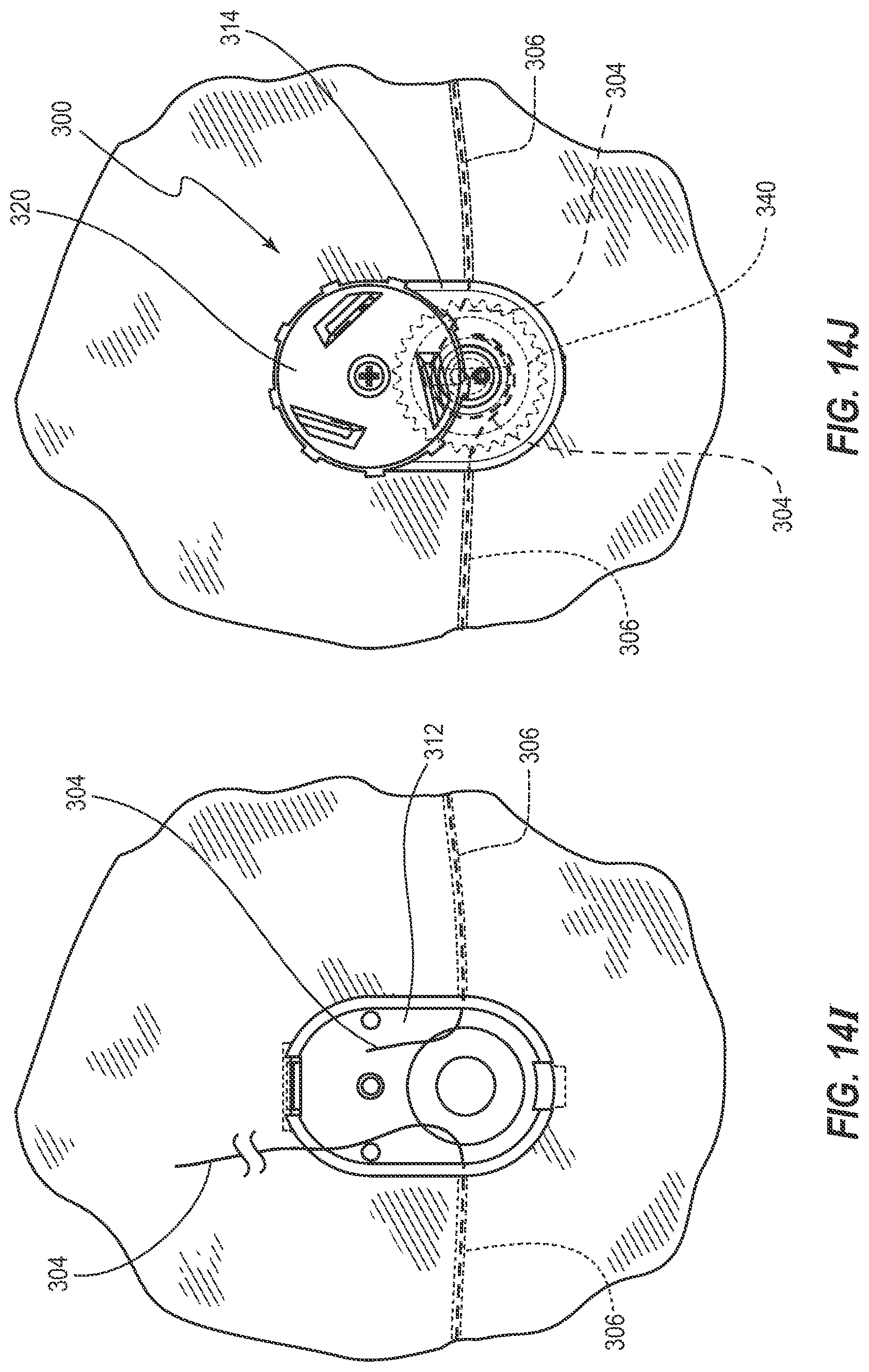 Patent US12310864 Figure 17 – Adjustable prosthetic interfaces and related systems and methods