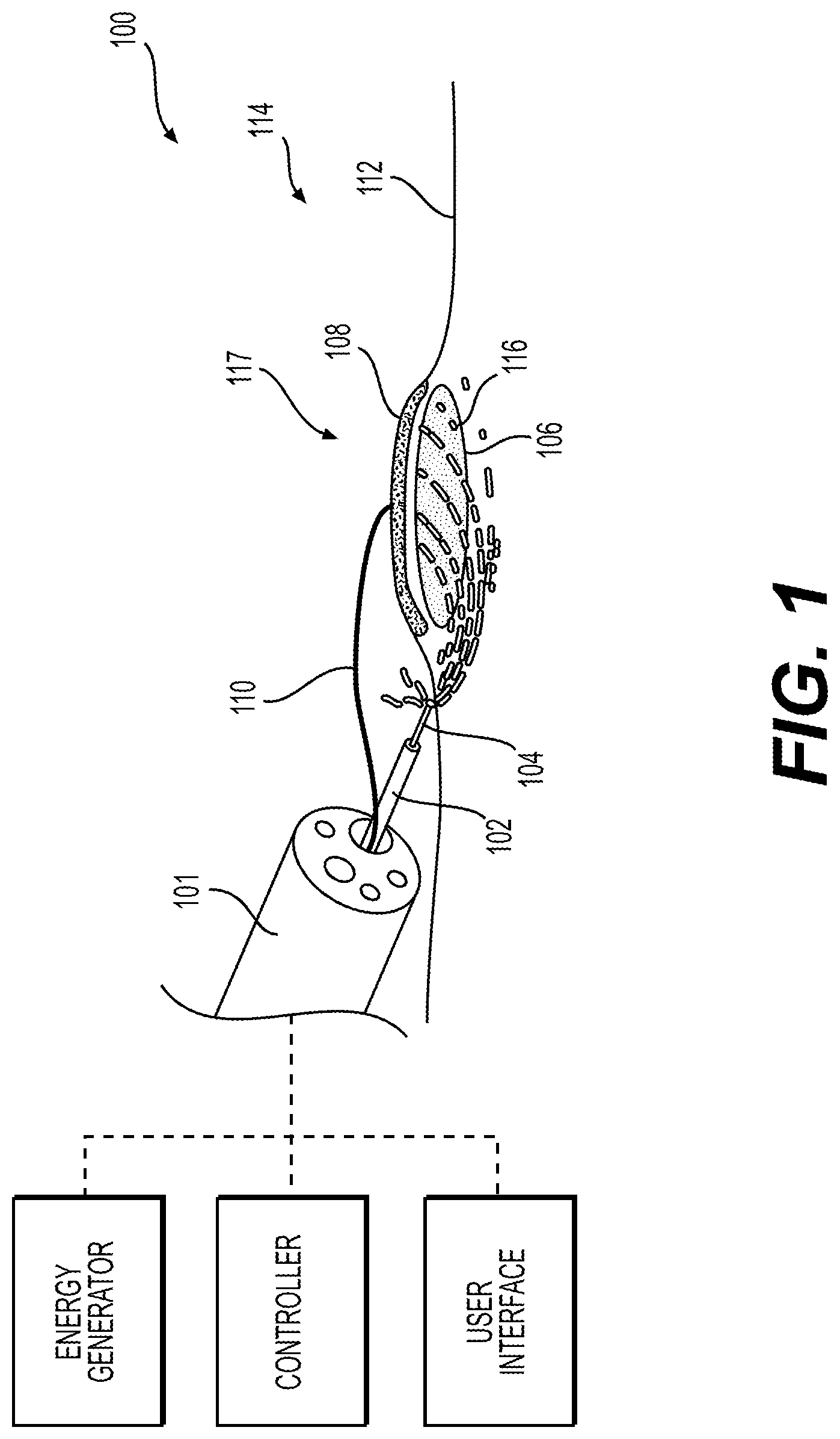 Patent US12310866 Figure 1 – Methods and devices for performing electrosurgery