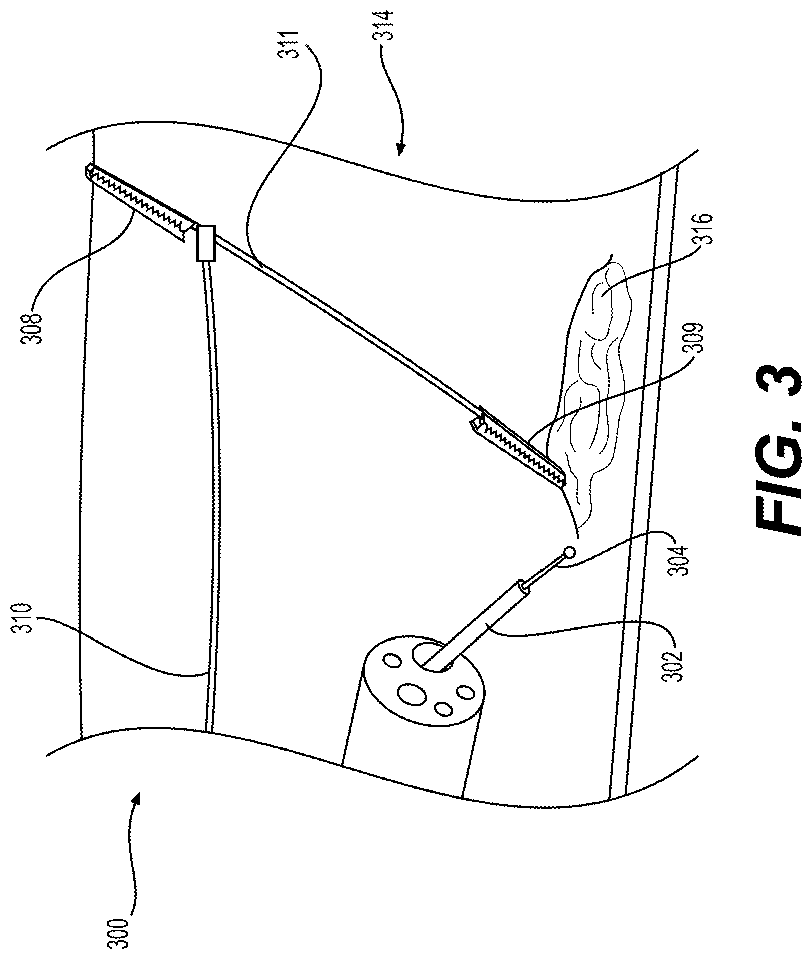 Patent US12310866 Figure 3 – Methods and devices for performing electrosurgery