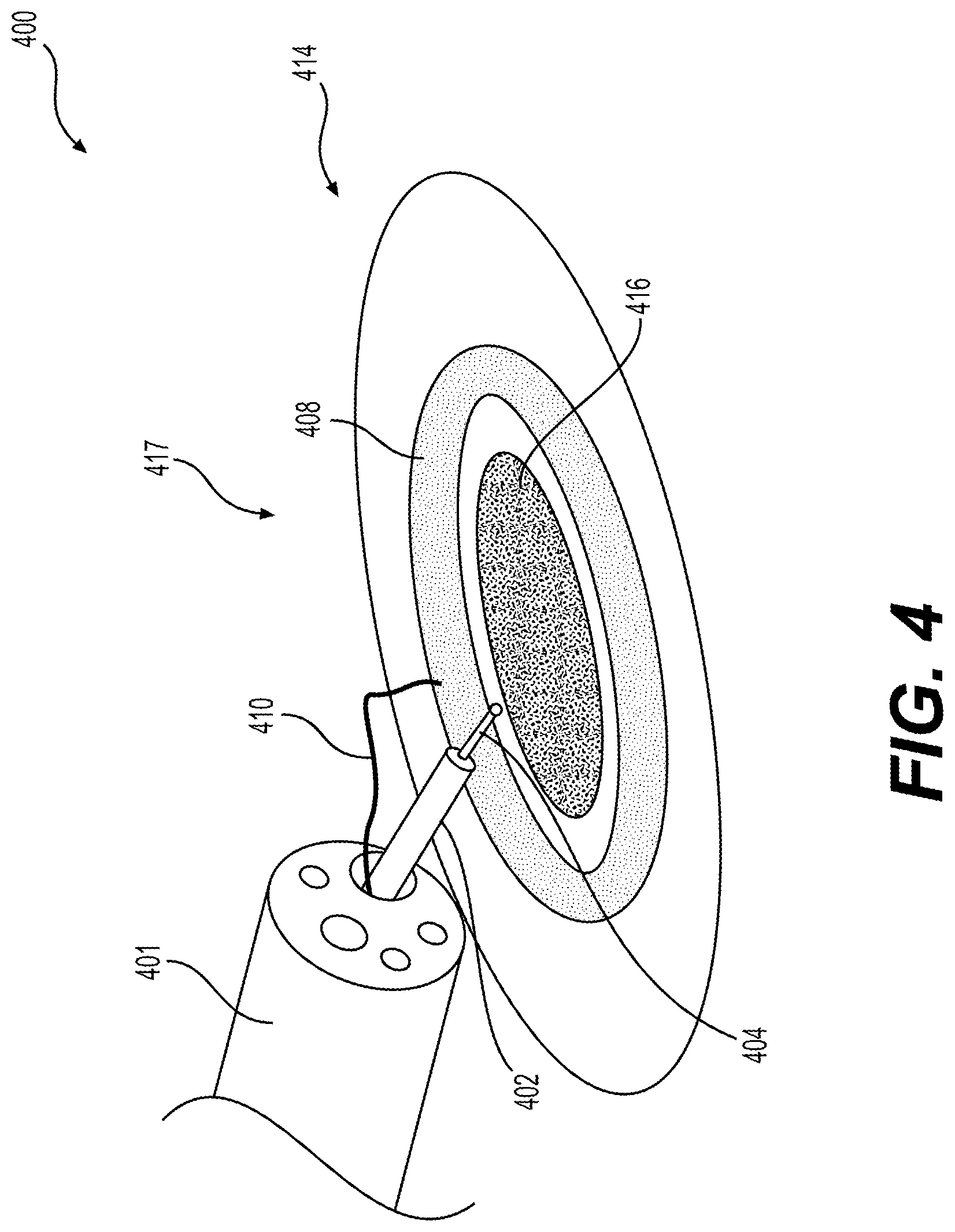 Patent US12310866 Figure 4 – Methods and devices for performing electrosurgery