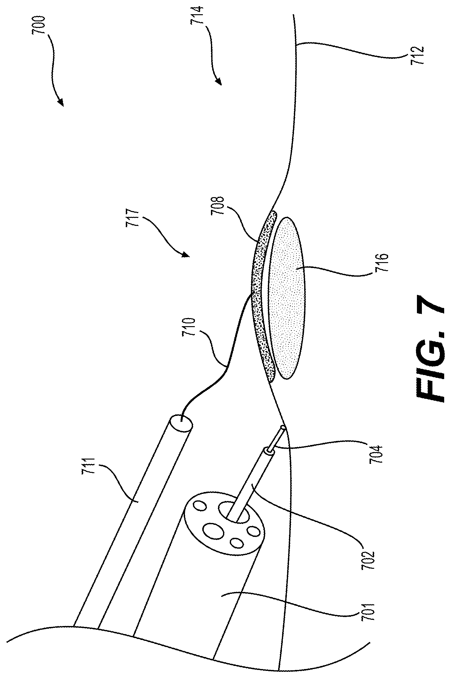 Patent US12310866 Figure 6 – Methods and devices for performing electrosurgery