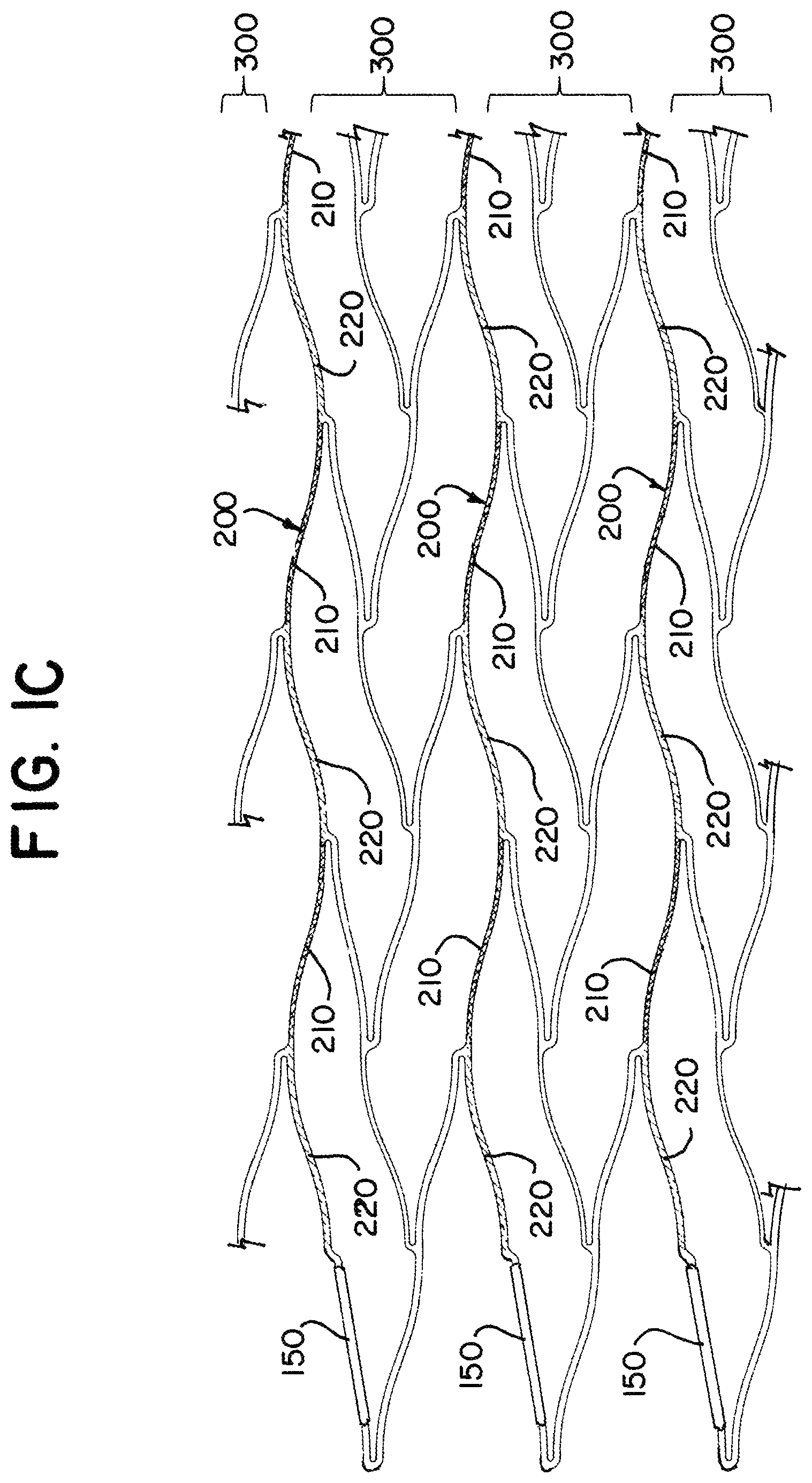 Patent US12310867 Figure 2 – Stent with longitudinal variable width struts