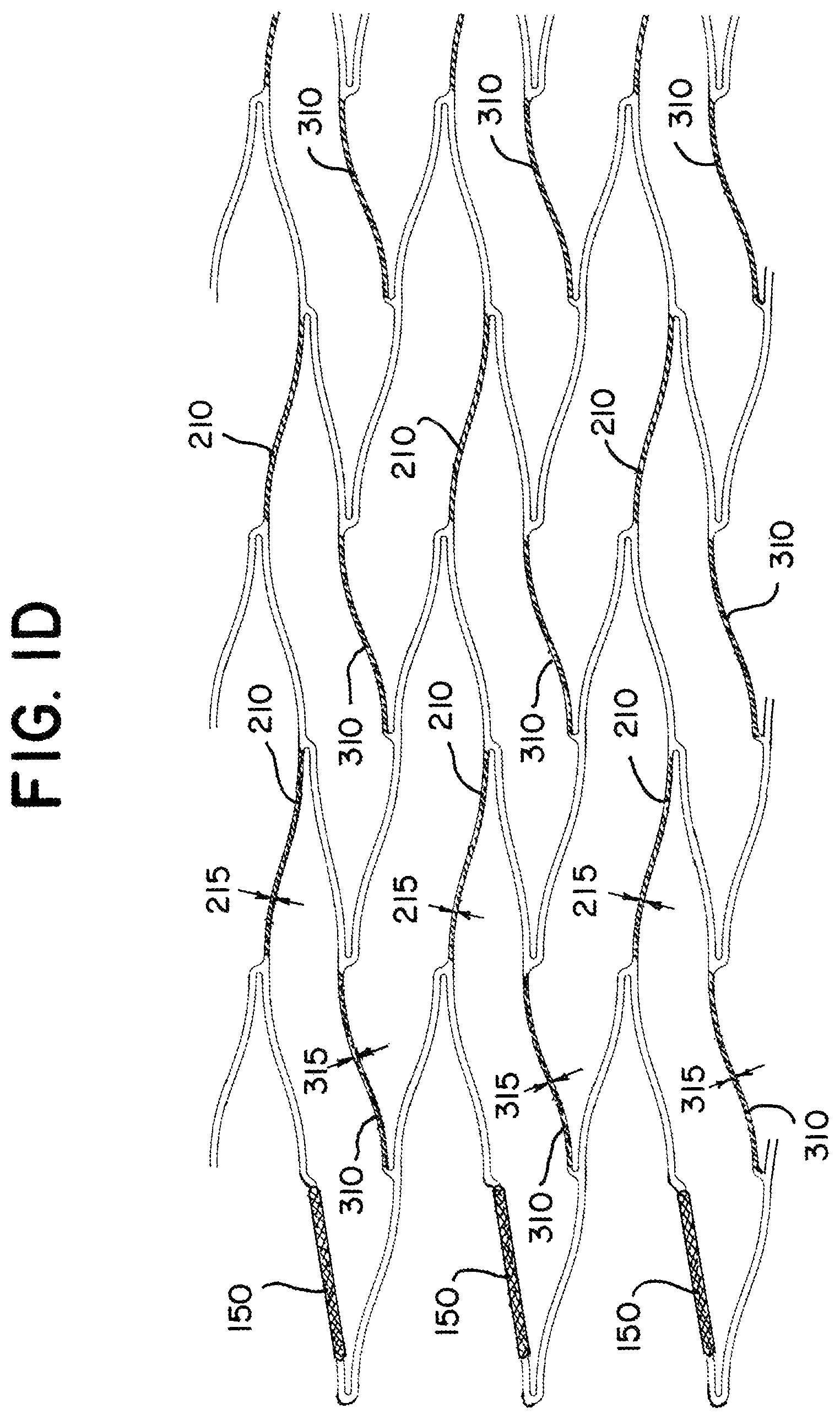 Patent US12310867 Figure 3 – Stent with longitudinal variable width struts