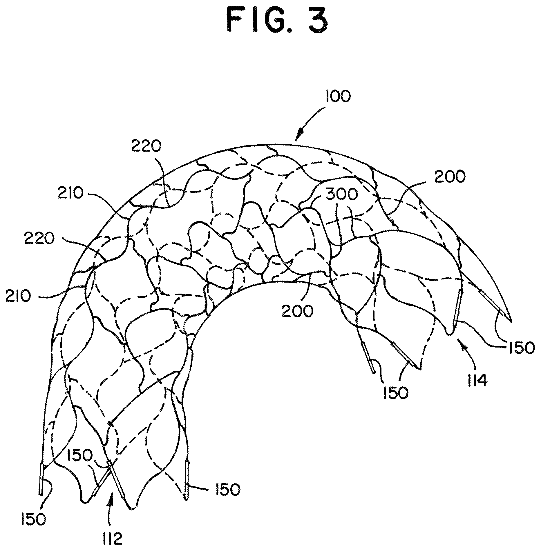 Patent US12310867 Figure 5 – Stent with longitudinal variable width struts