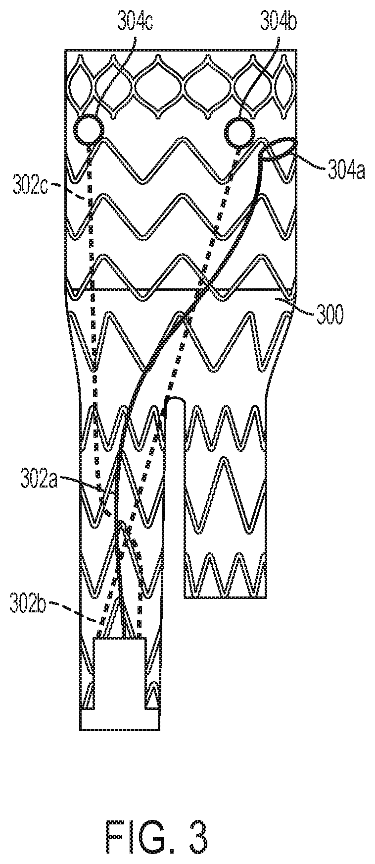 Patent US12310869 Figure 3 – Steering wire attach for angulation
