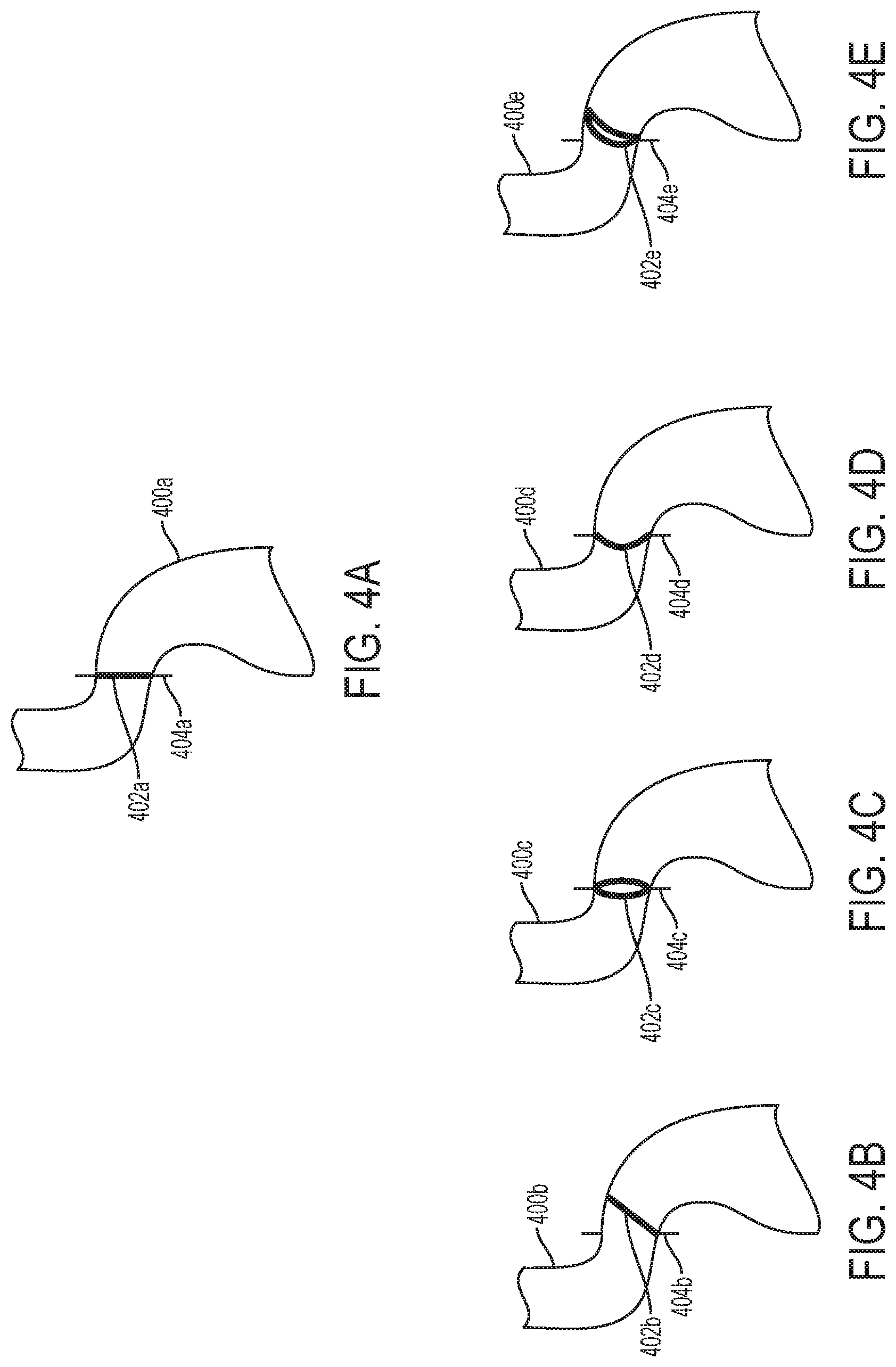 Patent US12310869 Figure 4 – Steering wire attach for angulation