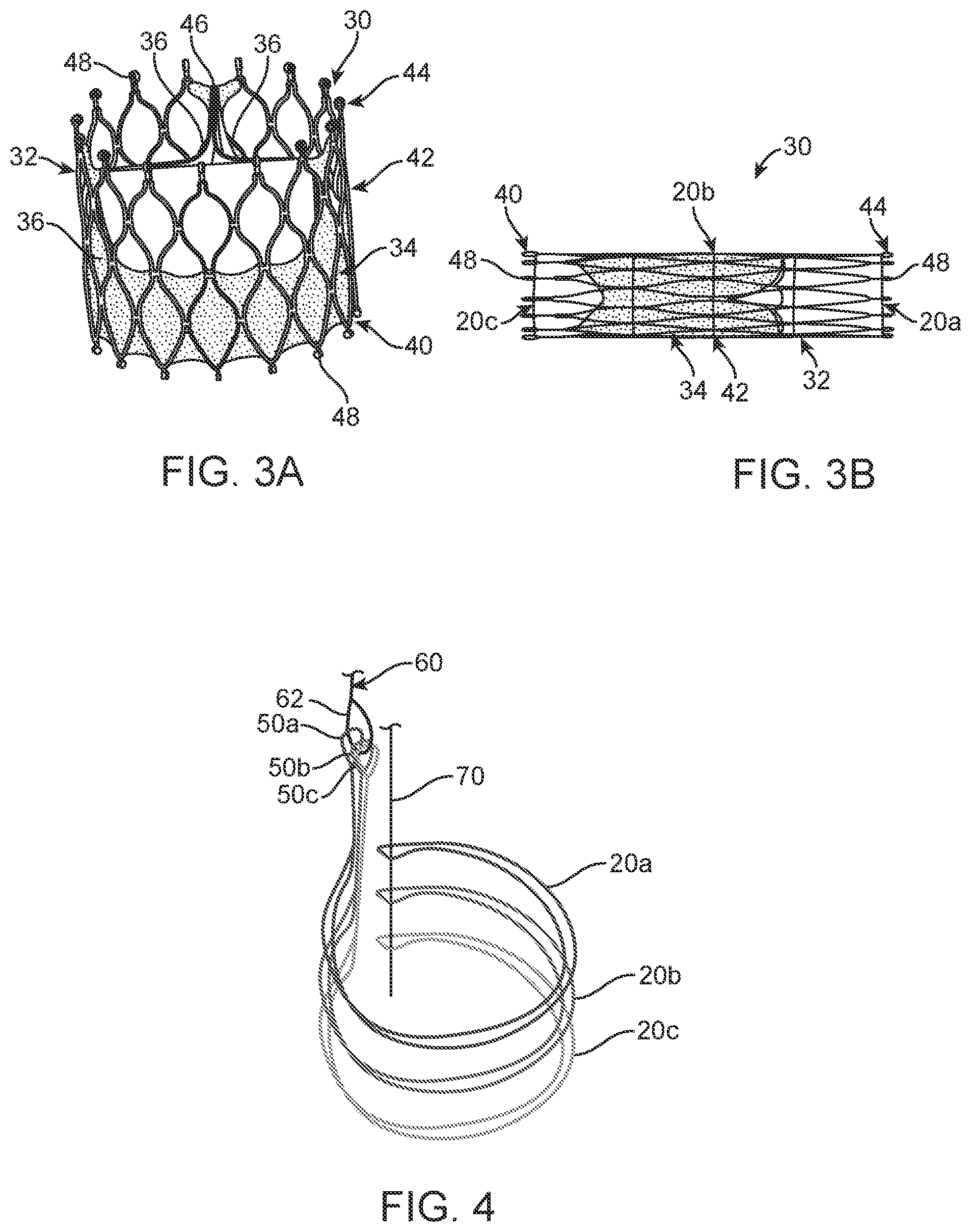 Patent US12310870 Figure 2 – Tension member routing designs to achieve transcatheter stented prosthesis compression