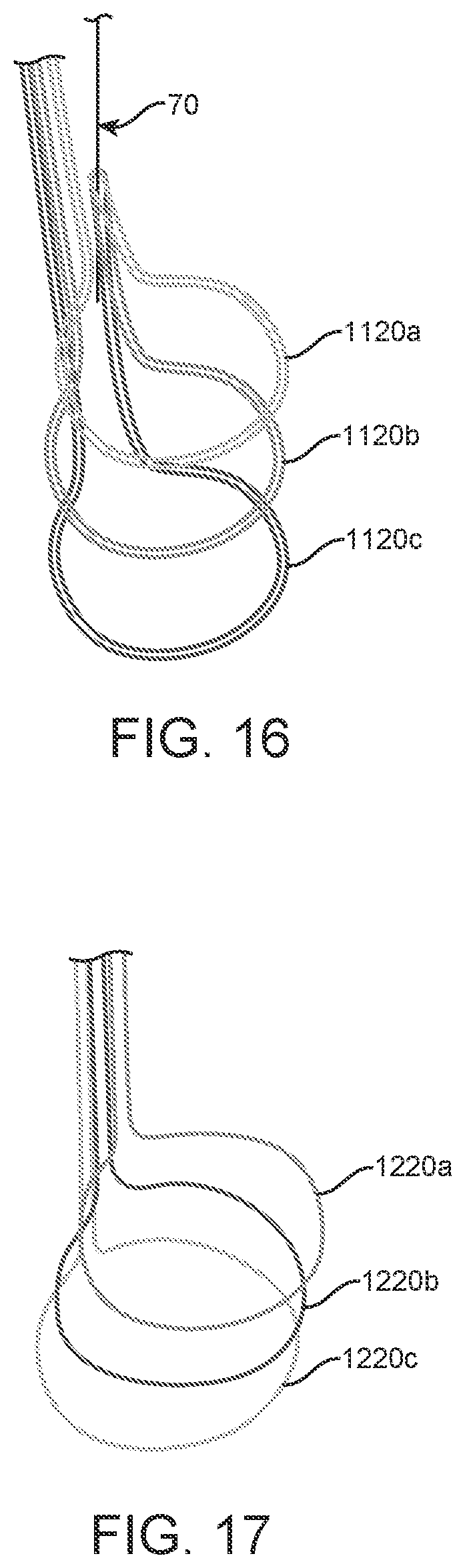 Patent US12310870 Figure 9 – Tension member routing designs to achieve transcatheter stented prosthesis compression