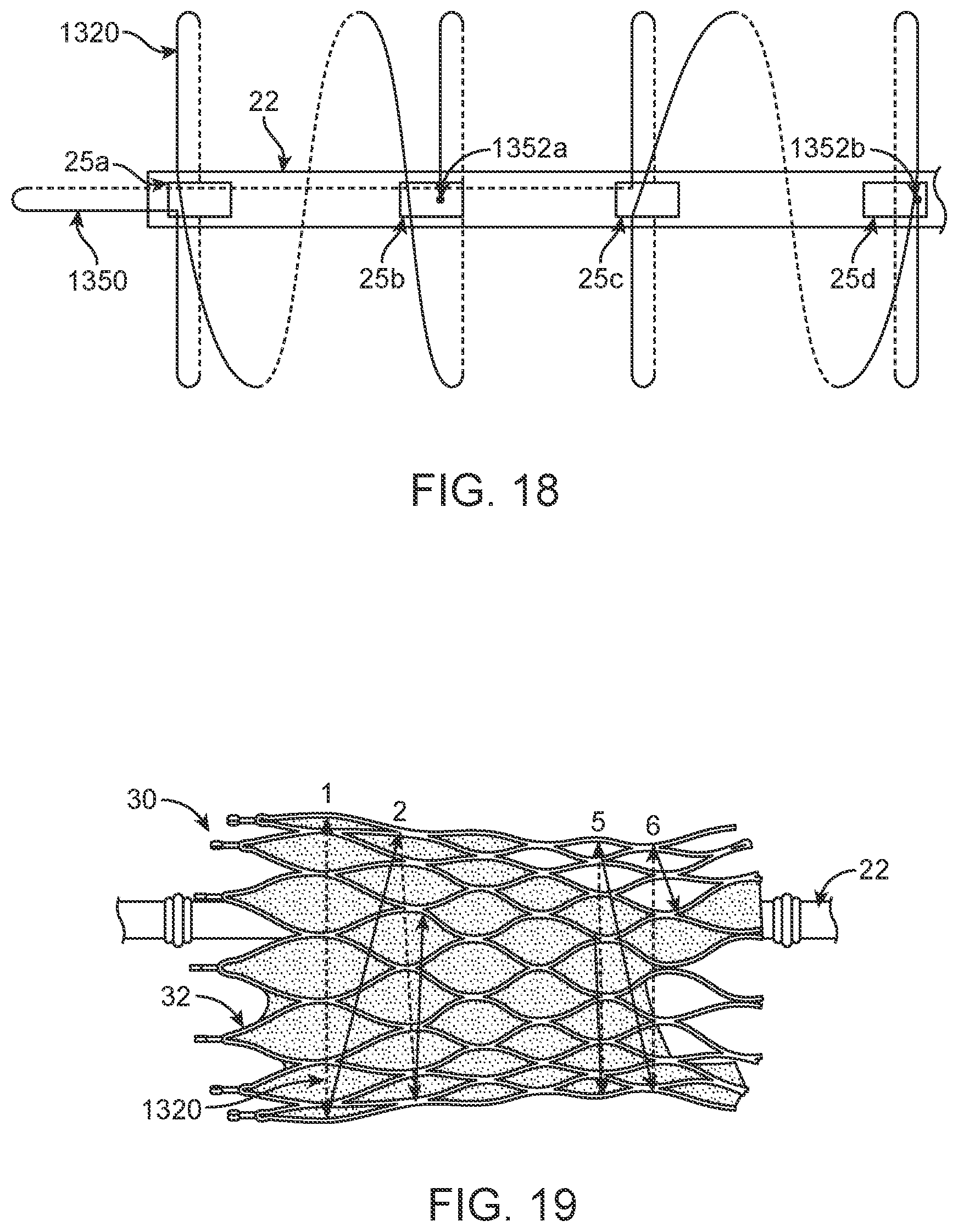 Patent US12310870 Figure 10 – Tension member routing designs to achieve transcatheter stented prosthesis compression
