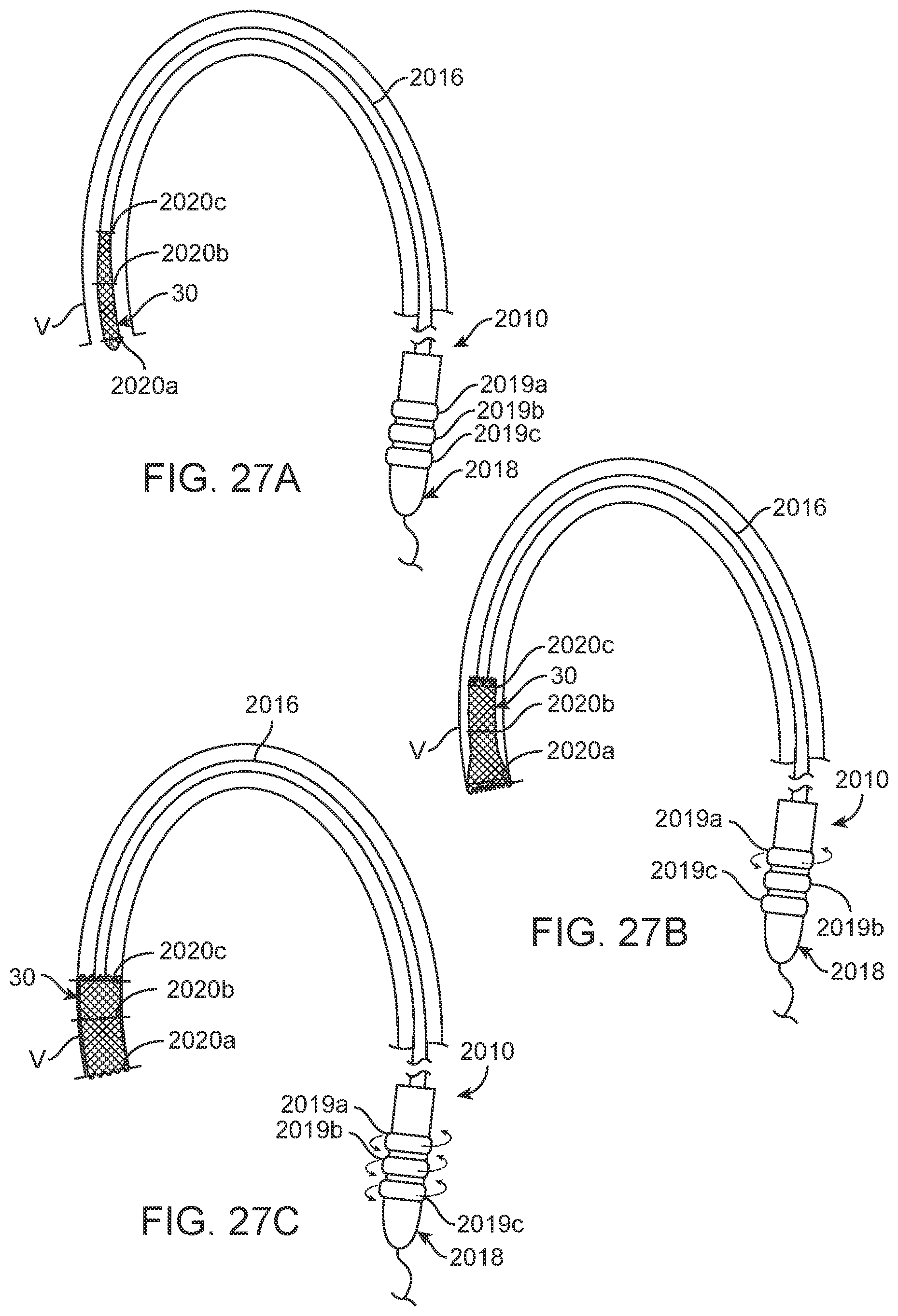 Patent US12310870 Figure 15 – Tension member routing designs to achieve transcatheter stented prosthesis compression