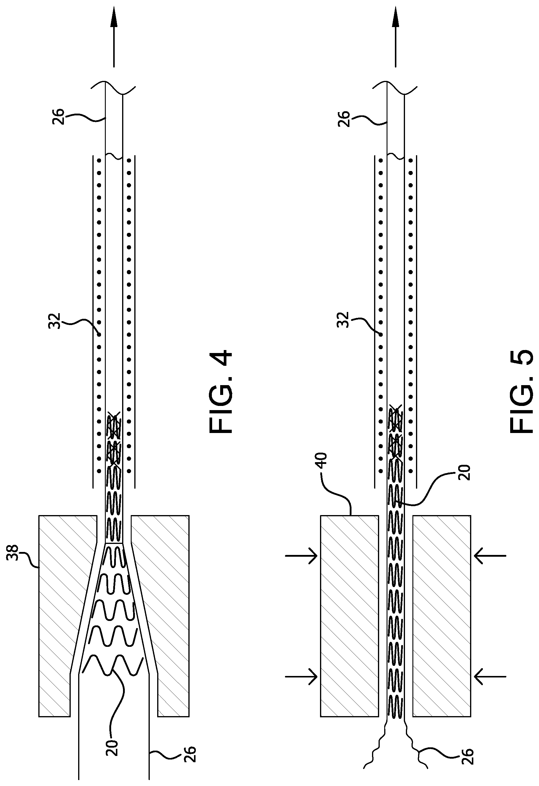 Patent US12310871 Figure 3 – Implantable medical device constraint and deployment apparatus