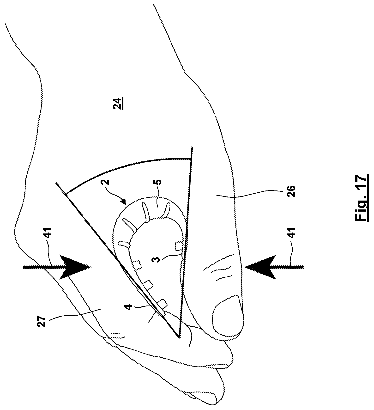 Patent US12310872 Figure 14 – Thumb orthosis and set of a plurality of thumb orthoses