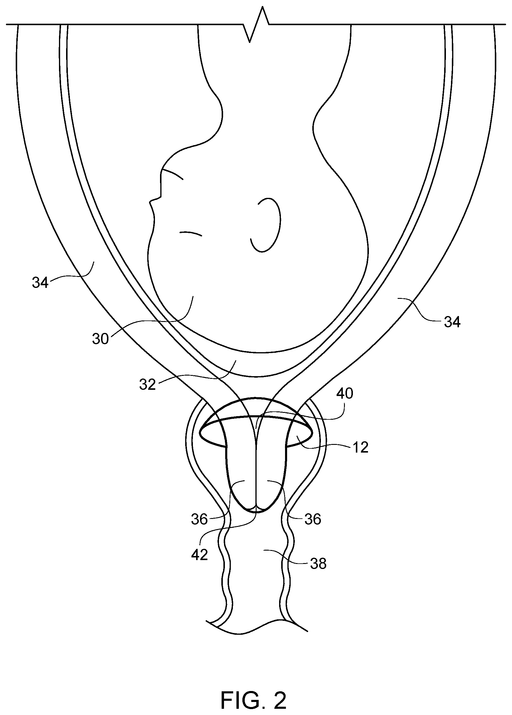 Patent US12310882 Figure 2 – Hannah cervical cup