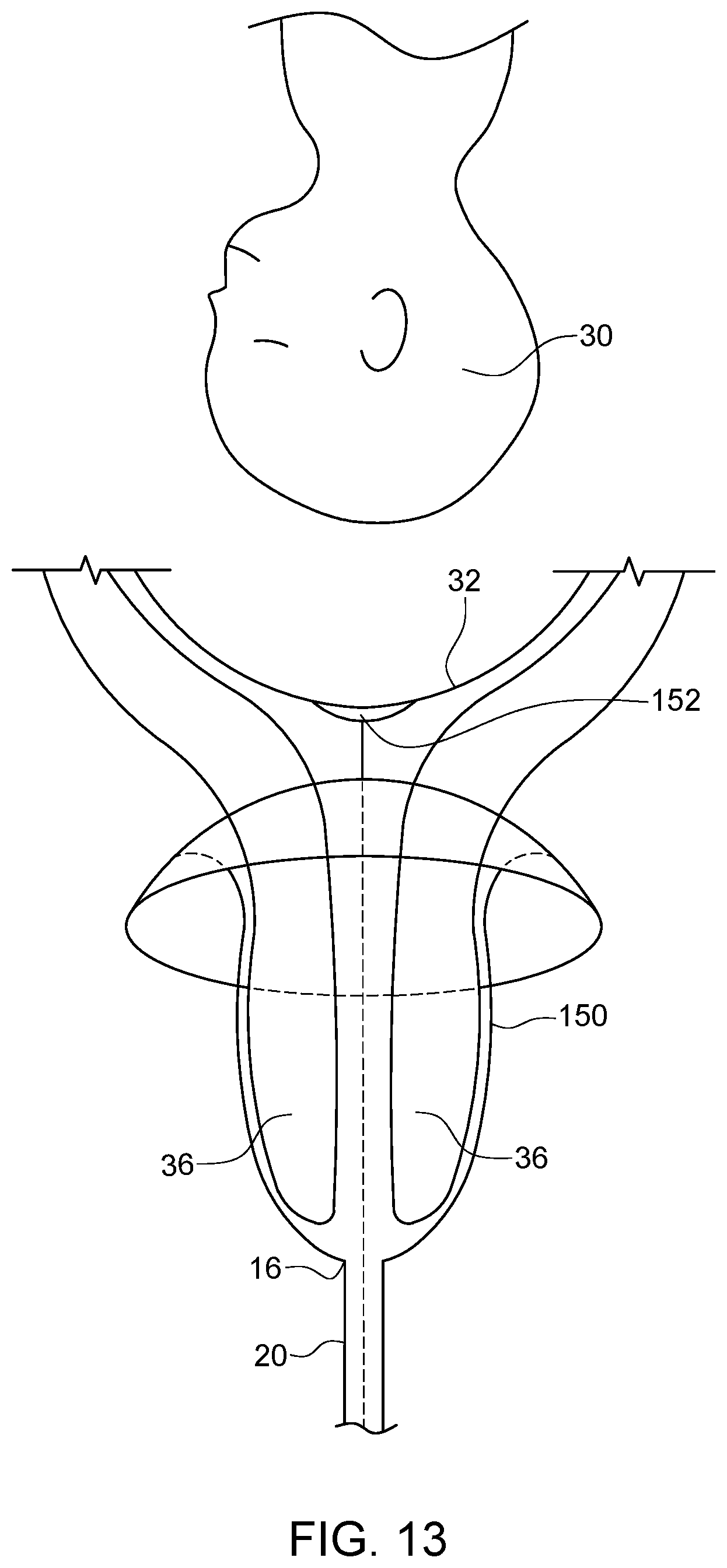 Patent US12310882 Figure 13 – Hannah cervical cup