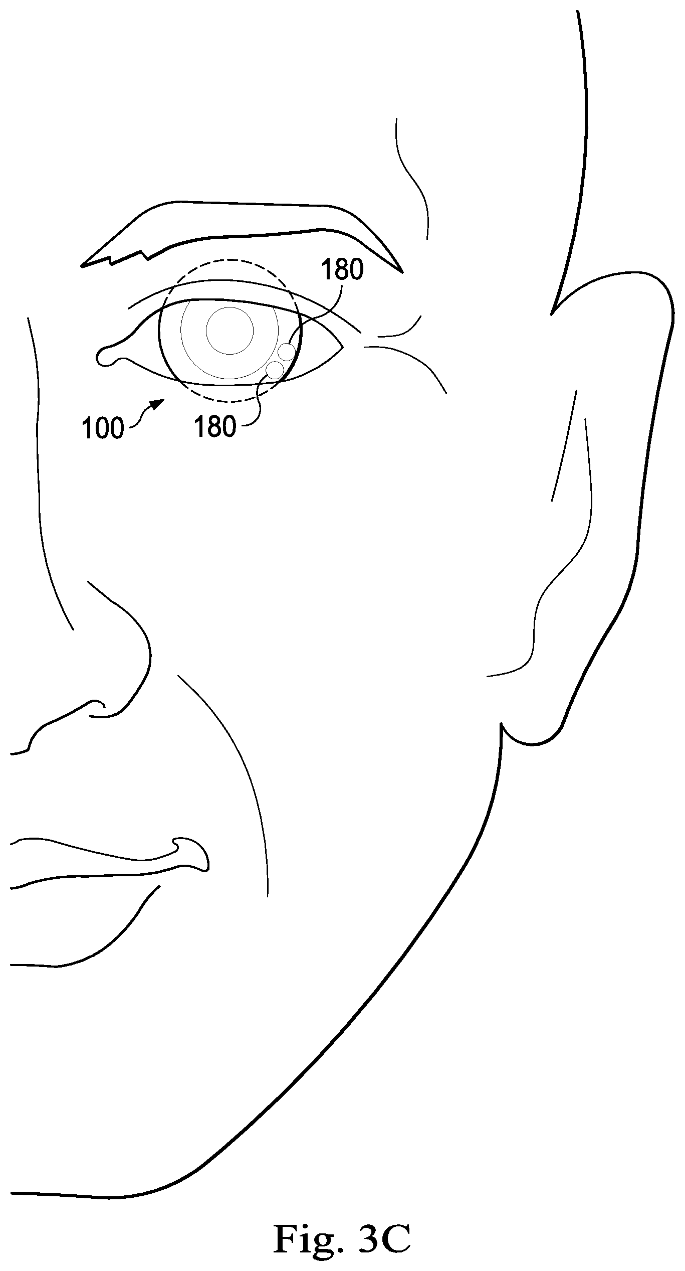 Patent US12310886 Figure 4 – Ophthalmic devices, systems and methods for treating dry eye