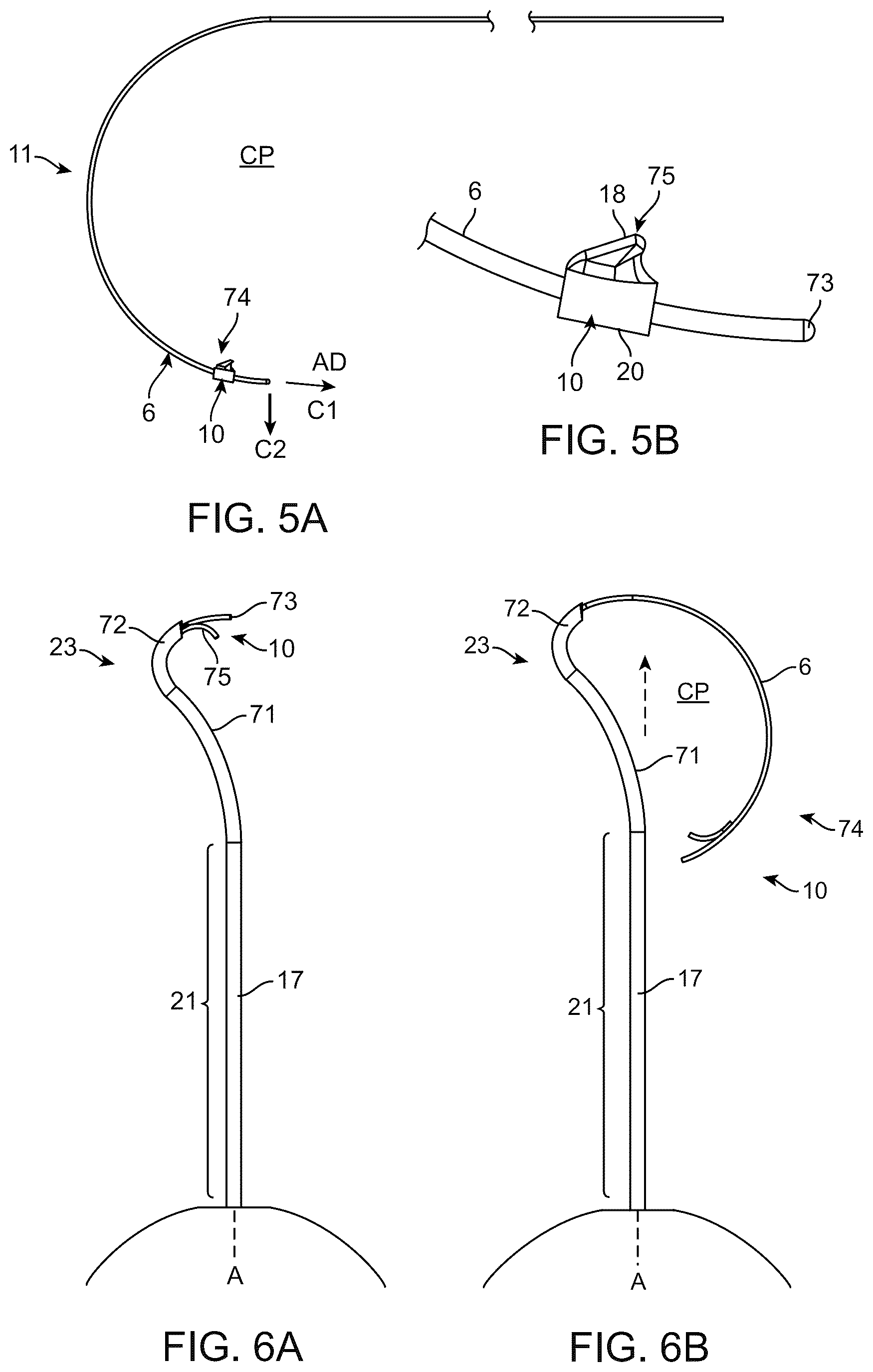 Patent US12310892 Figure 5 – Methods and devices for increasing aqueous drainage of the eye