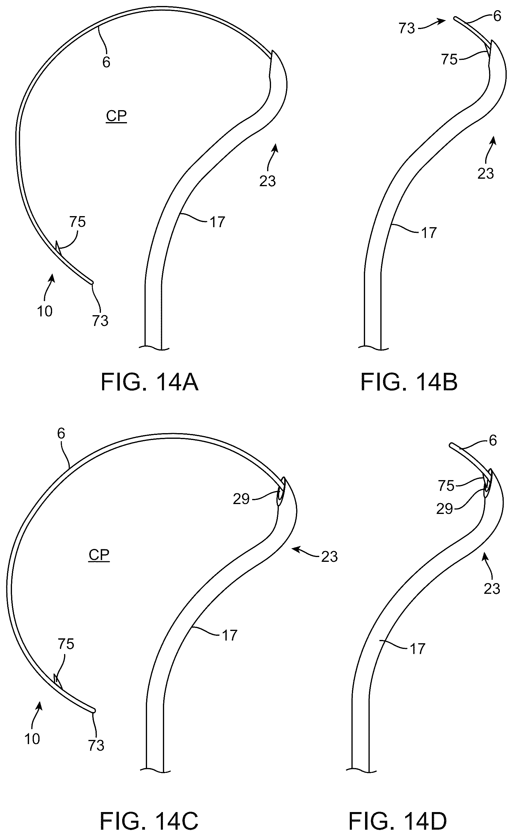 Patent US12310892 Figure 11 – Methods and devices for increasing aqueous drainage of the eye