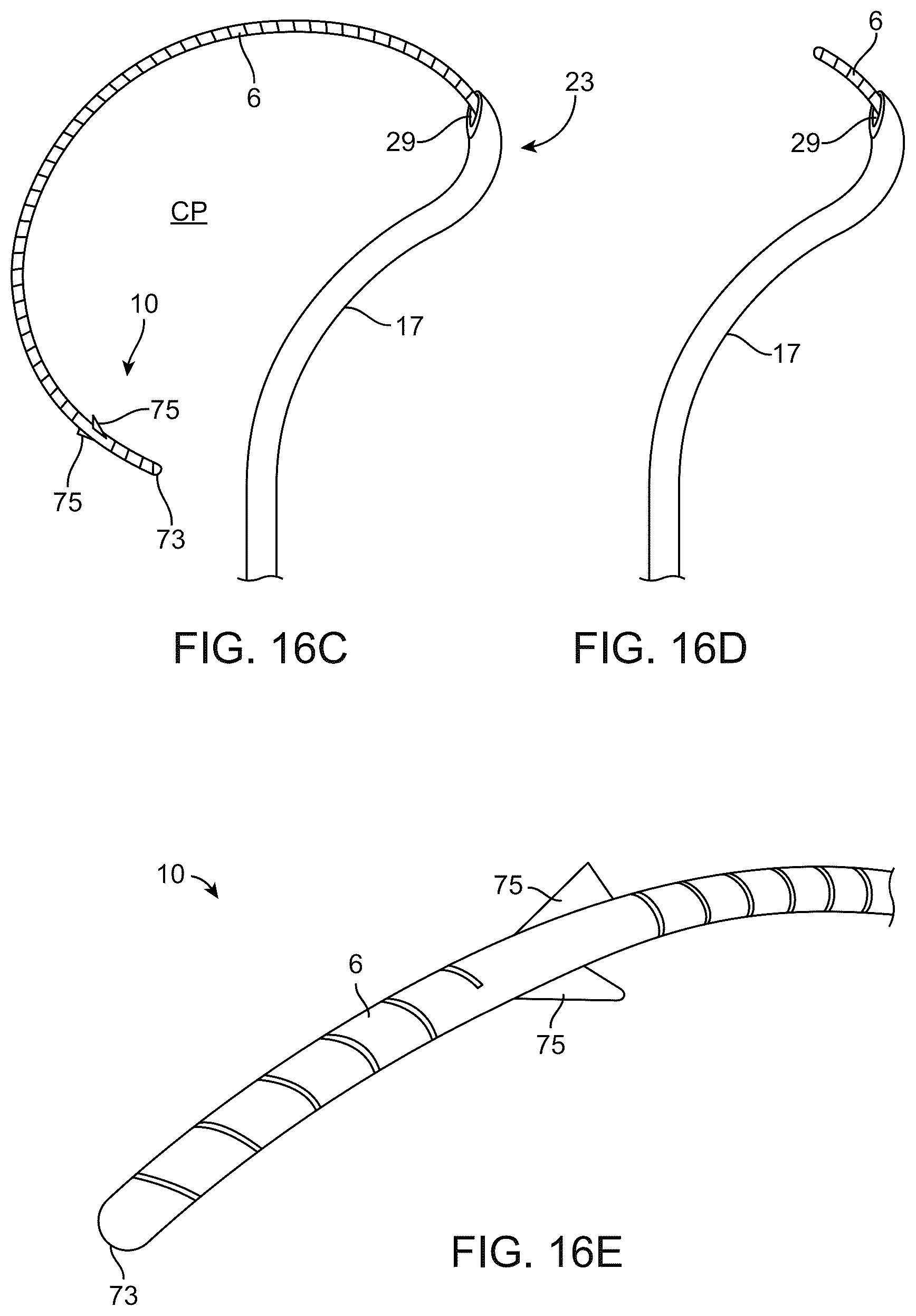 Patent US12310892 Figure 14 – Methods and devices for increasing aqueous drainage of the eye