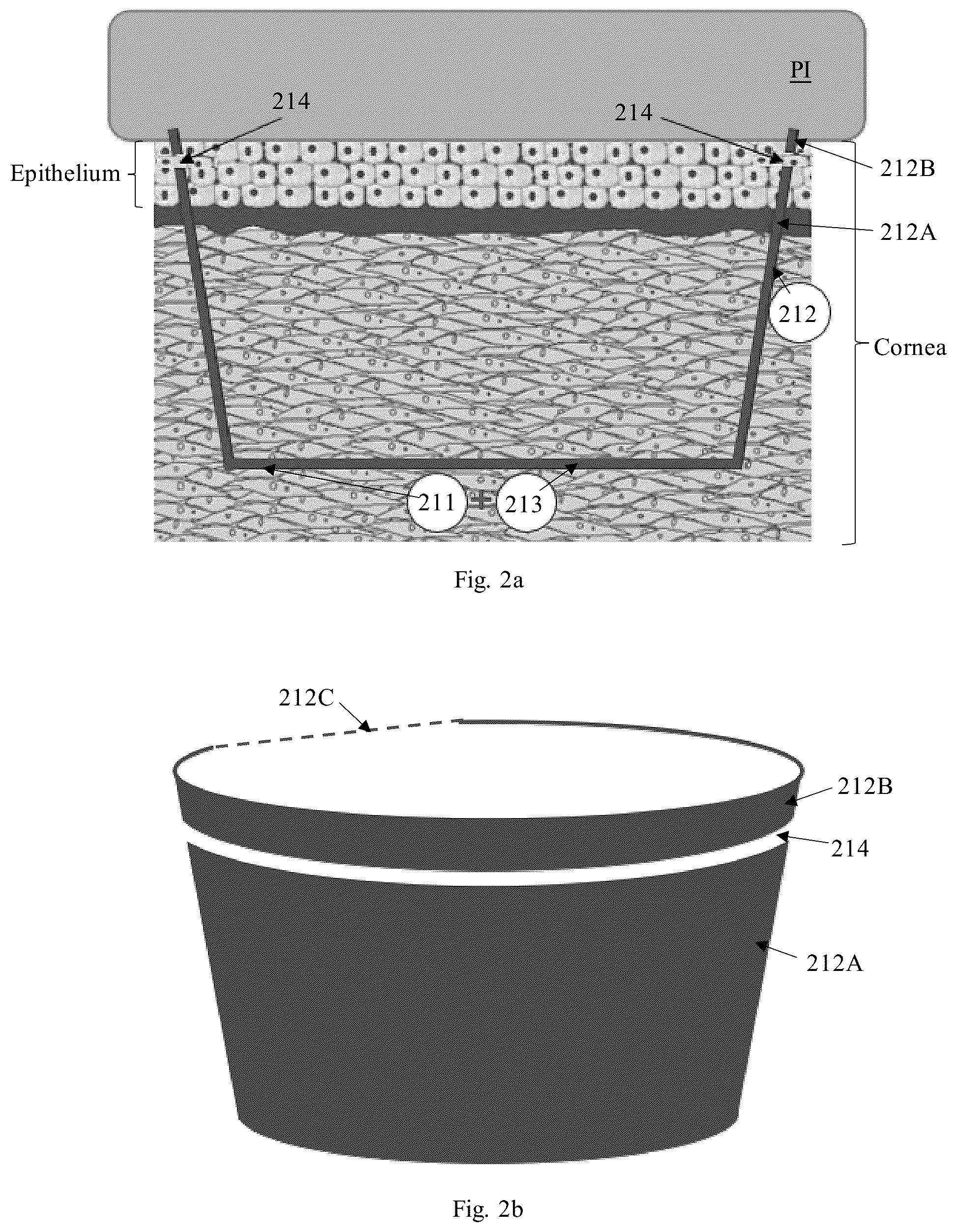Patent US12310895 Figure 2 – Lasik flap cutting patterns including bubble barrier layer in side cut for bubble management
